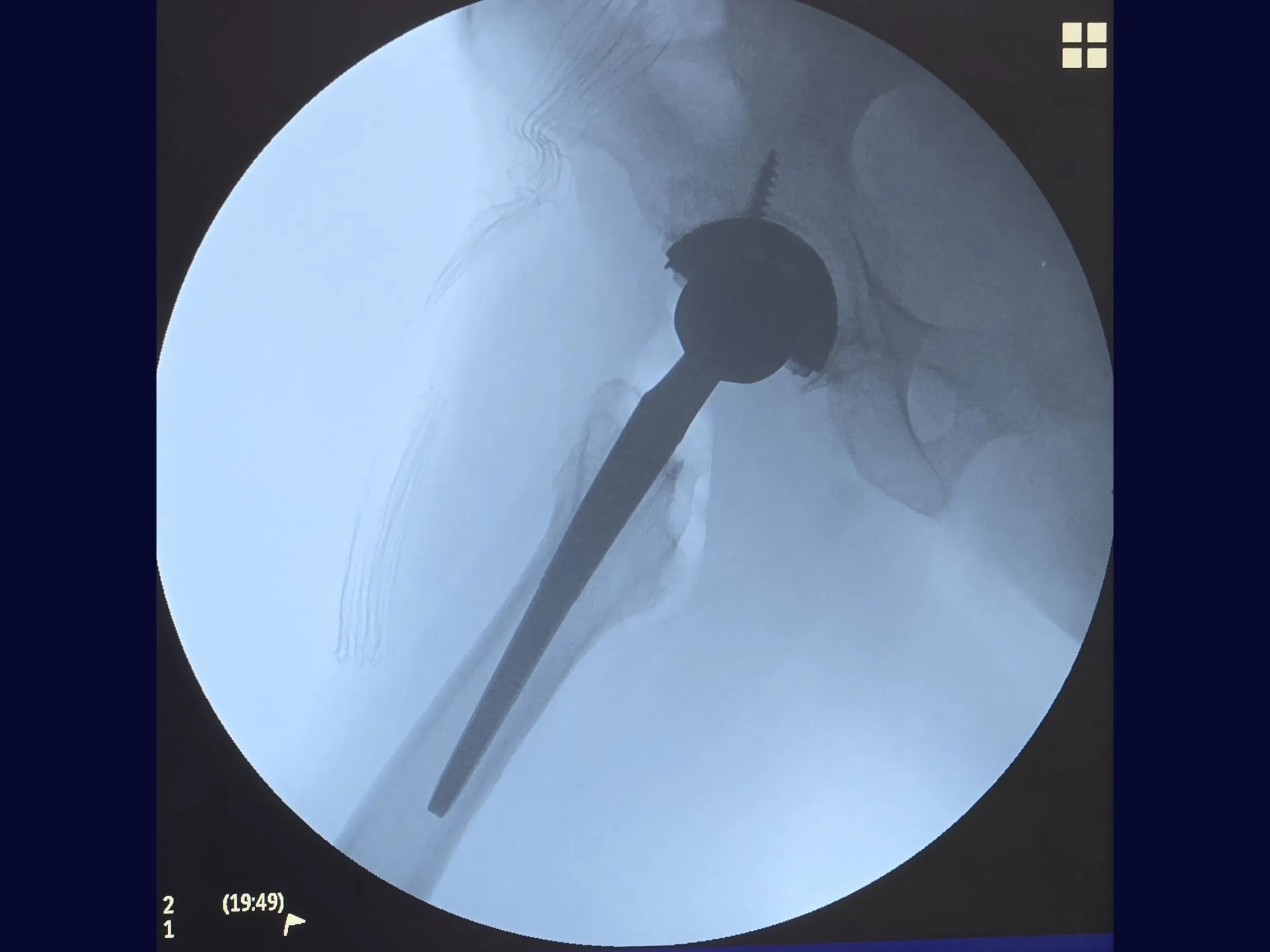 Artroplastia Total Do Quadril - Abordagem Posterior