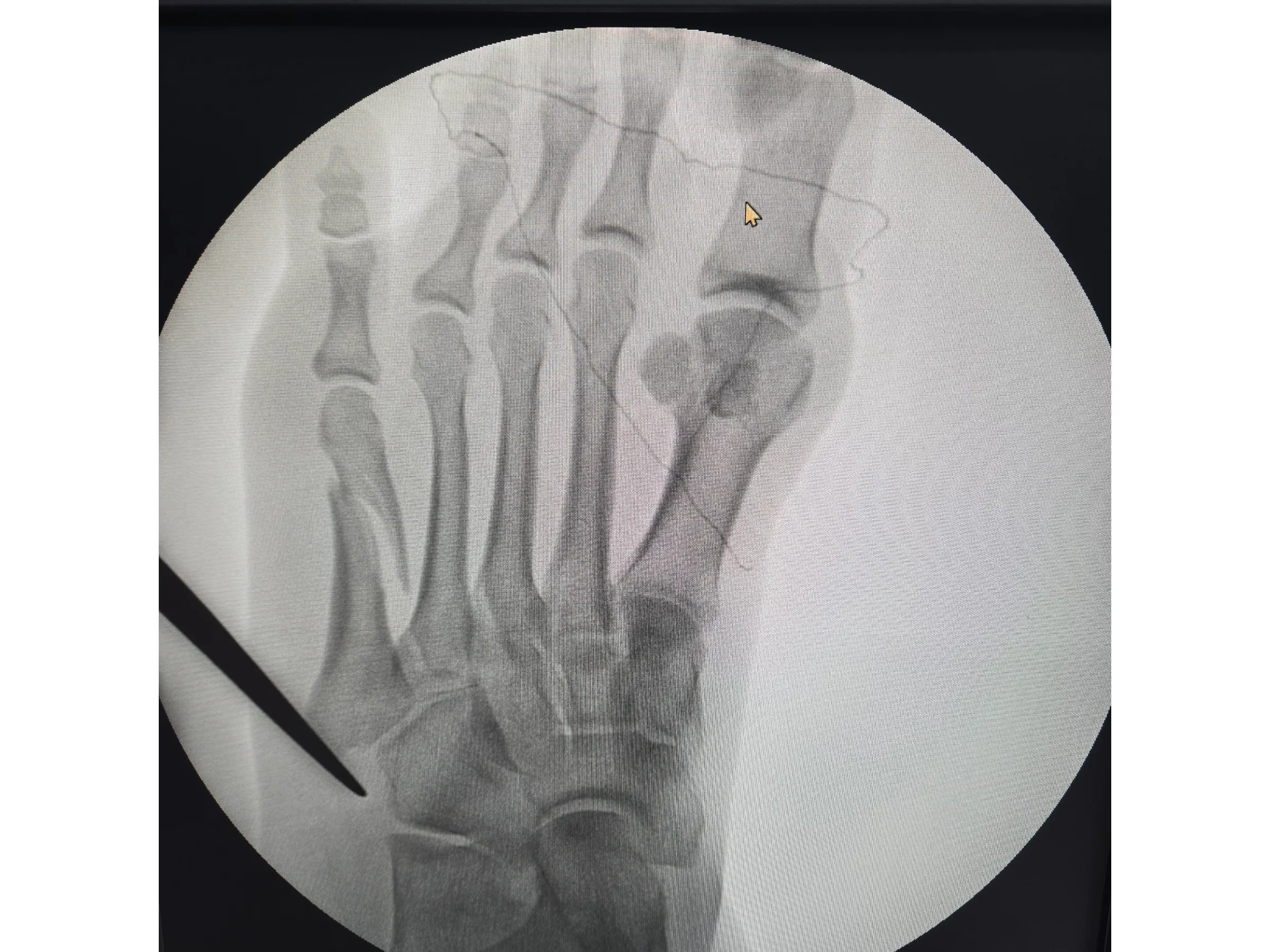 QUINTO METATARSO [Caso 2] · Placa e Parafusos de Minifragmentos