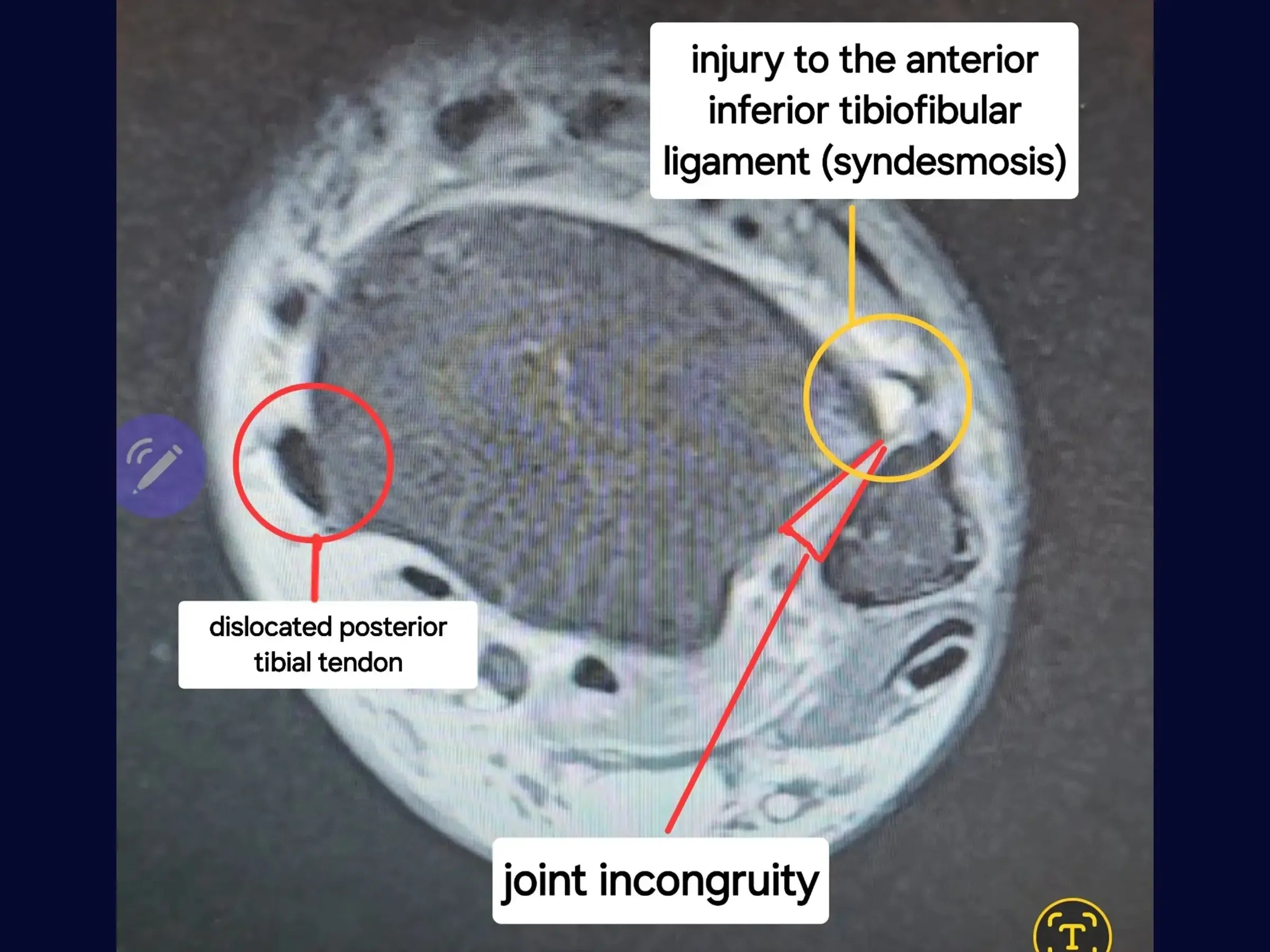 360-Degree Reconstruction for Complex Ankle Injuries (Achilles Tendon, Posterior Tibial, and Ligamentous Injuries)