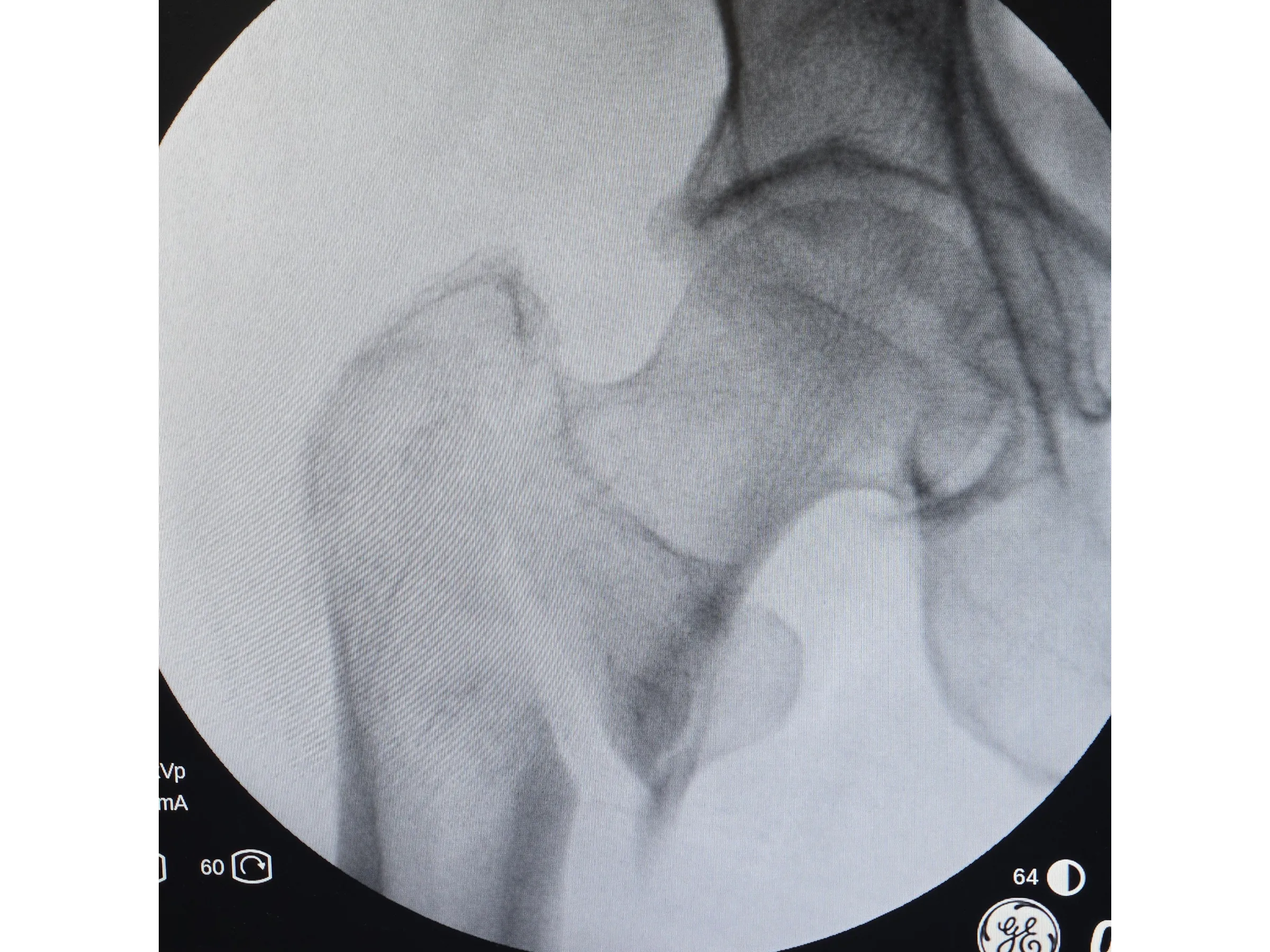 FÊMUR PROXIMAL [Caso 4] · Dupla Técnica da Gangorra