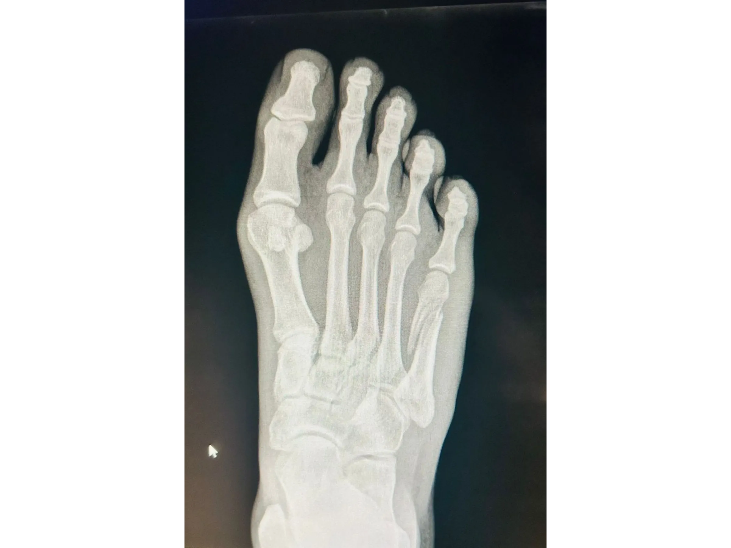 QUINTO METATARSO [Caso 2] · Placa e Parafusos de Minifragmentos