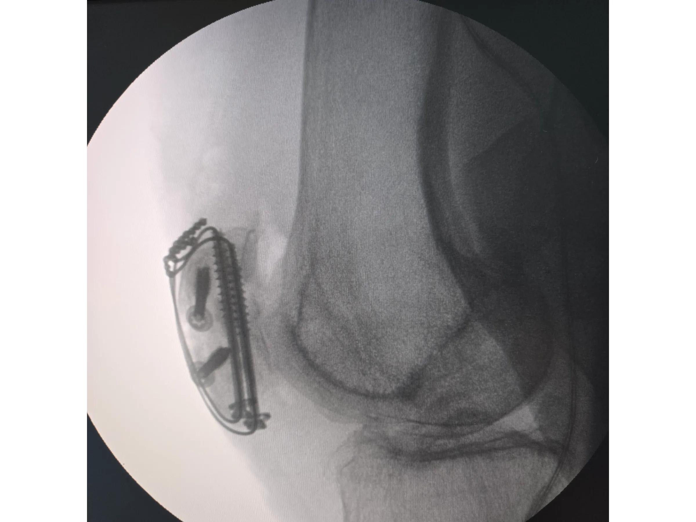 PATELA [Caso 2] · Parafusos Canulados + Cerclagem