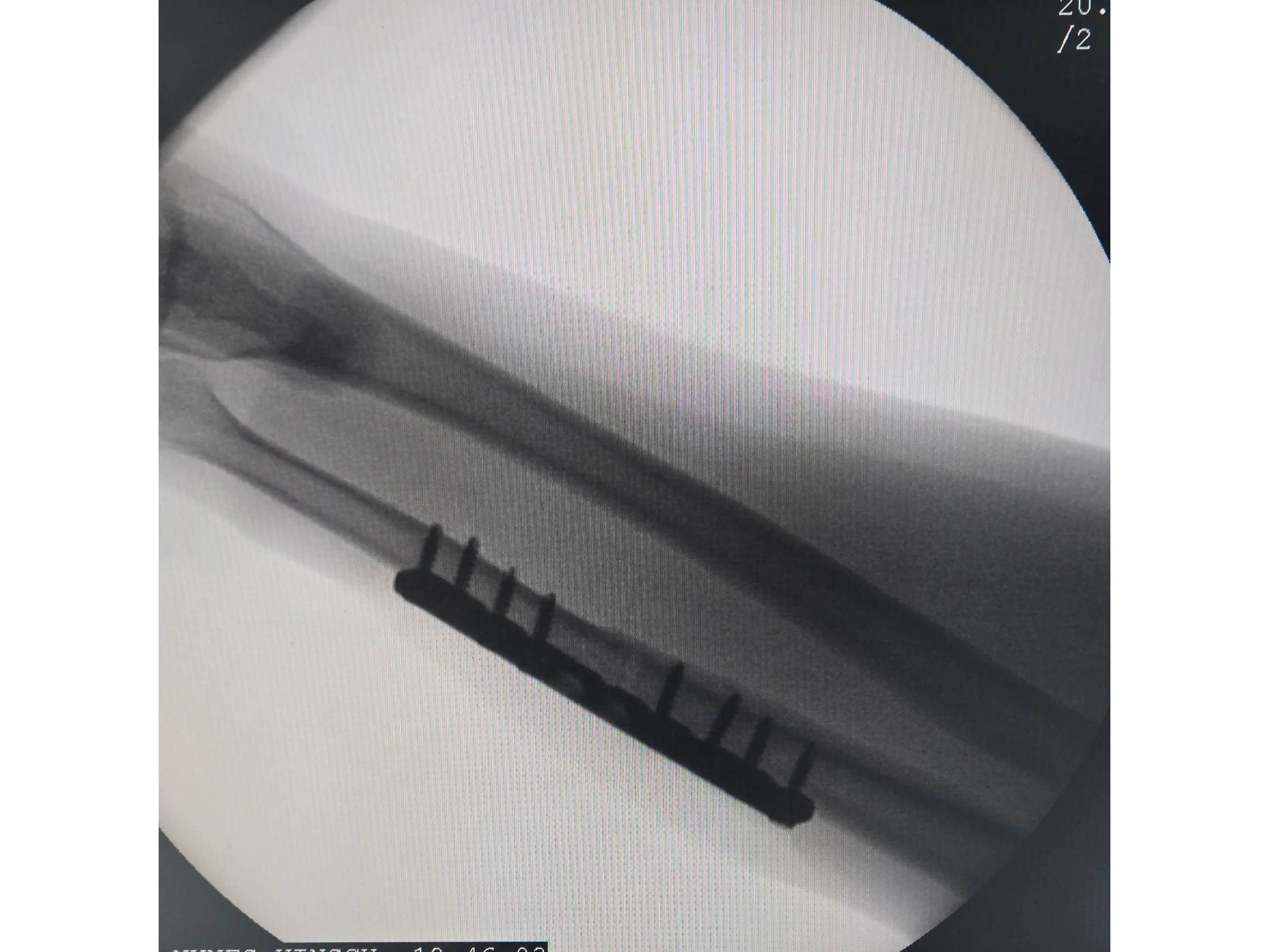 DIÁFISE DA ULNA [Caso 2] · Placa e Parafusos