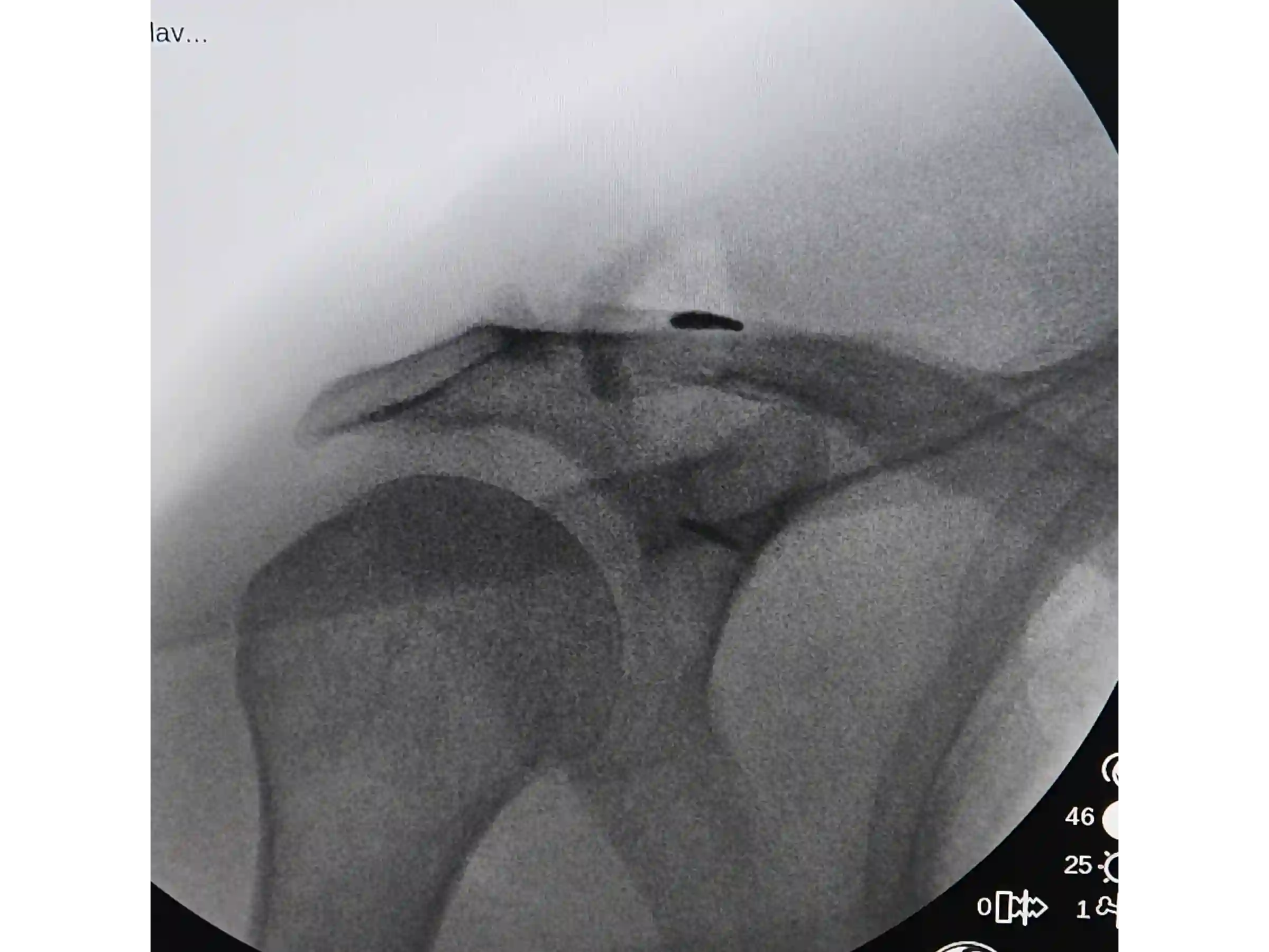 ACROMIOCLAVICULAR [CASO 3] Fixação com TightRope