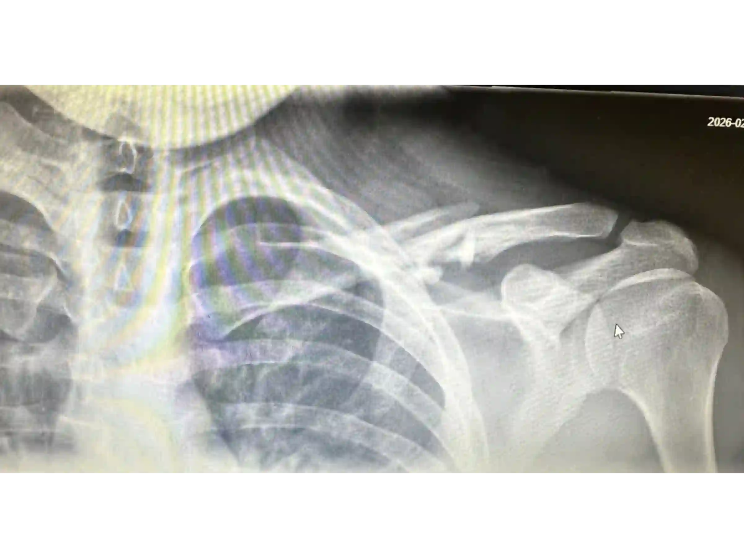 CLAVICLE [CASE 03] - Minimally Invasive Percutaneous Osteosynthesis