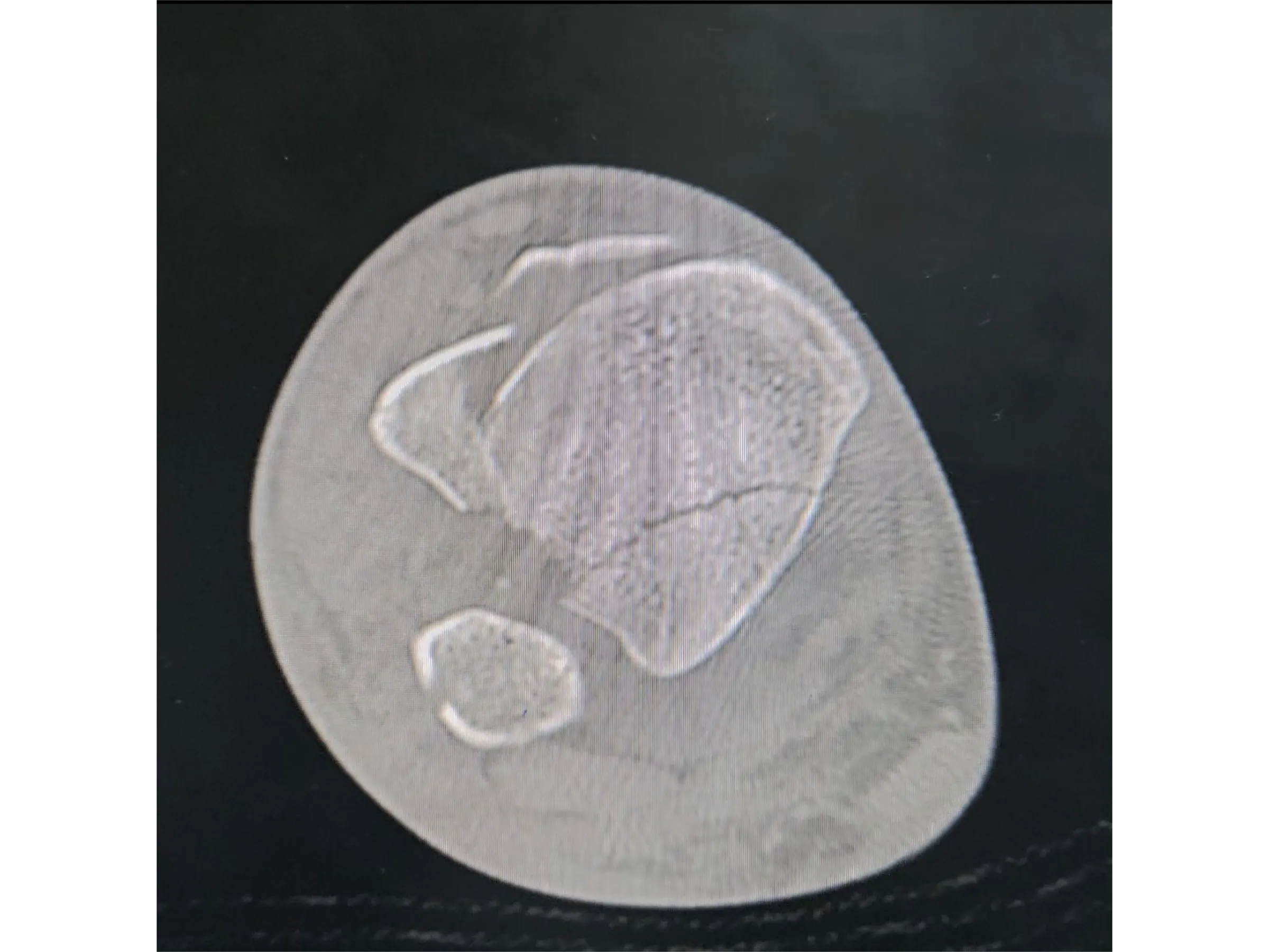 PILÃO TIBIAL [Caso 2] · Abordagem Póstero-Medial + Lateral