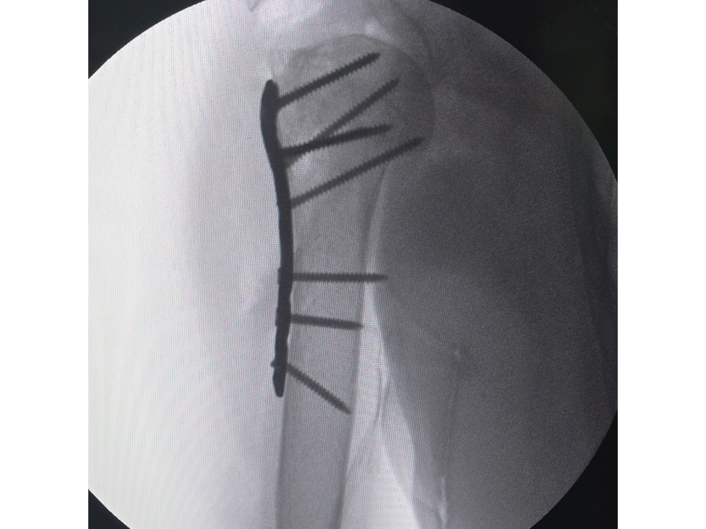 ÚMERO PROXIMAL [Caso 6] · Duas Partes · Placa e Parafusos