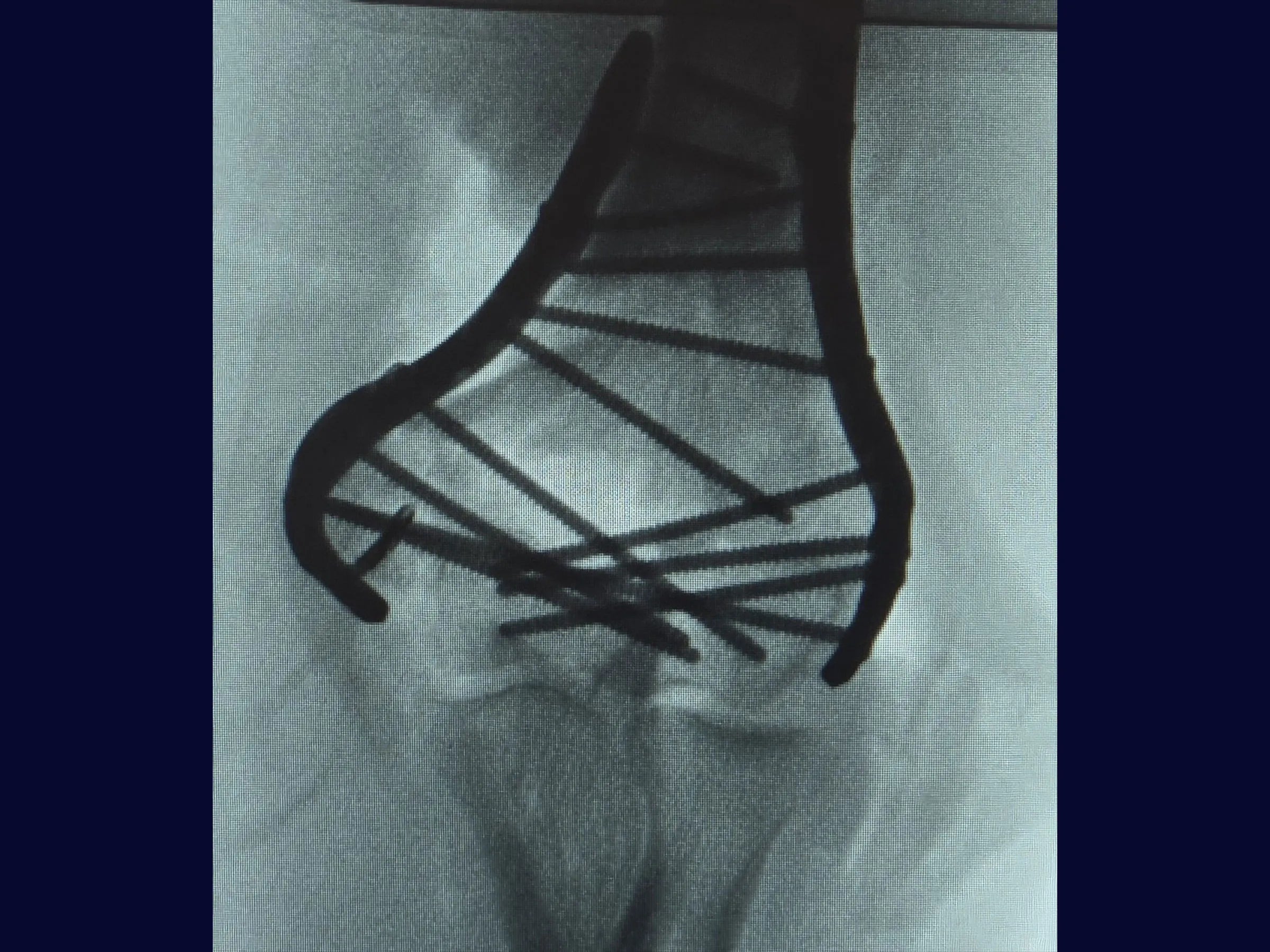 Fratura Articular Cominutiva do Úmero Distal