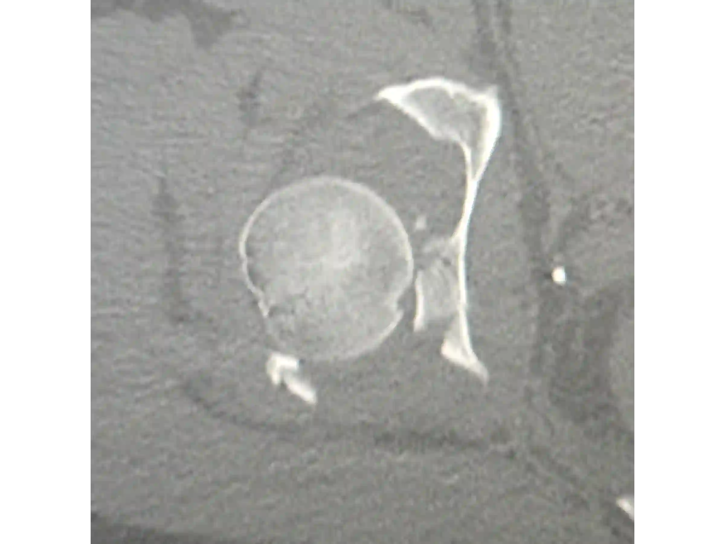 ACETÁBULO [CASO 02] · Rebordo Posterior + Impacção Articular