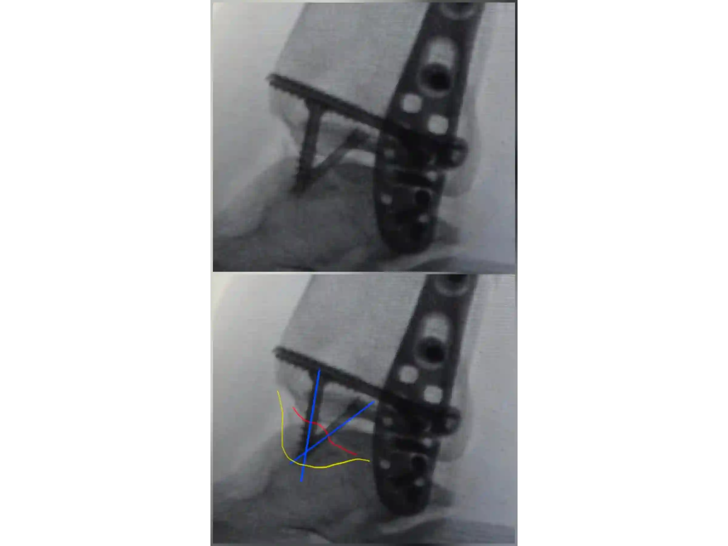 TRIMALEOLAR [CASO 03] Abordagem posterolateral + fixação anterógrada do maléolo medial