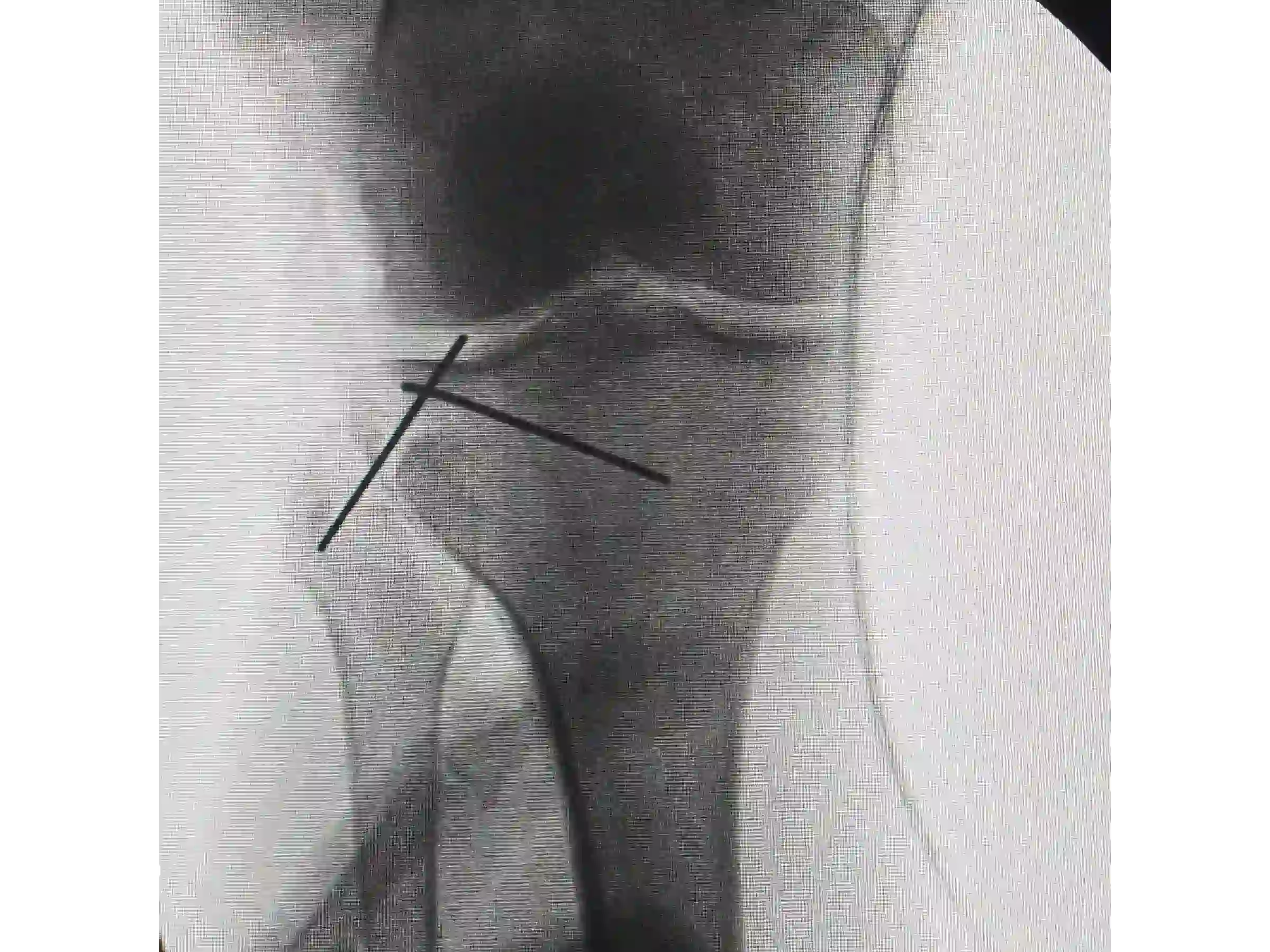 PLANALTO TIBIAL [CASO 03] Jail Technique Afundamento Posterolateral