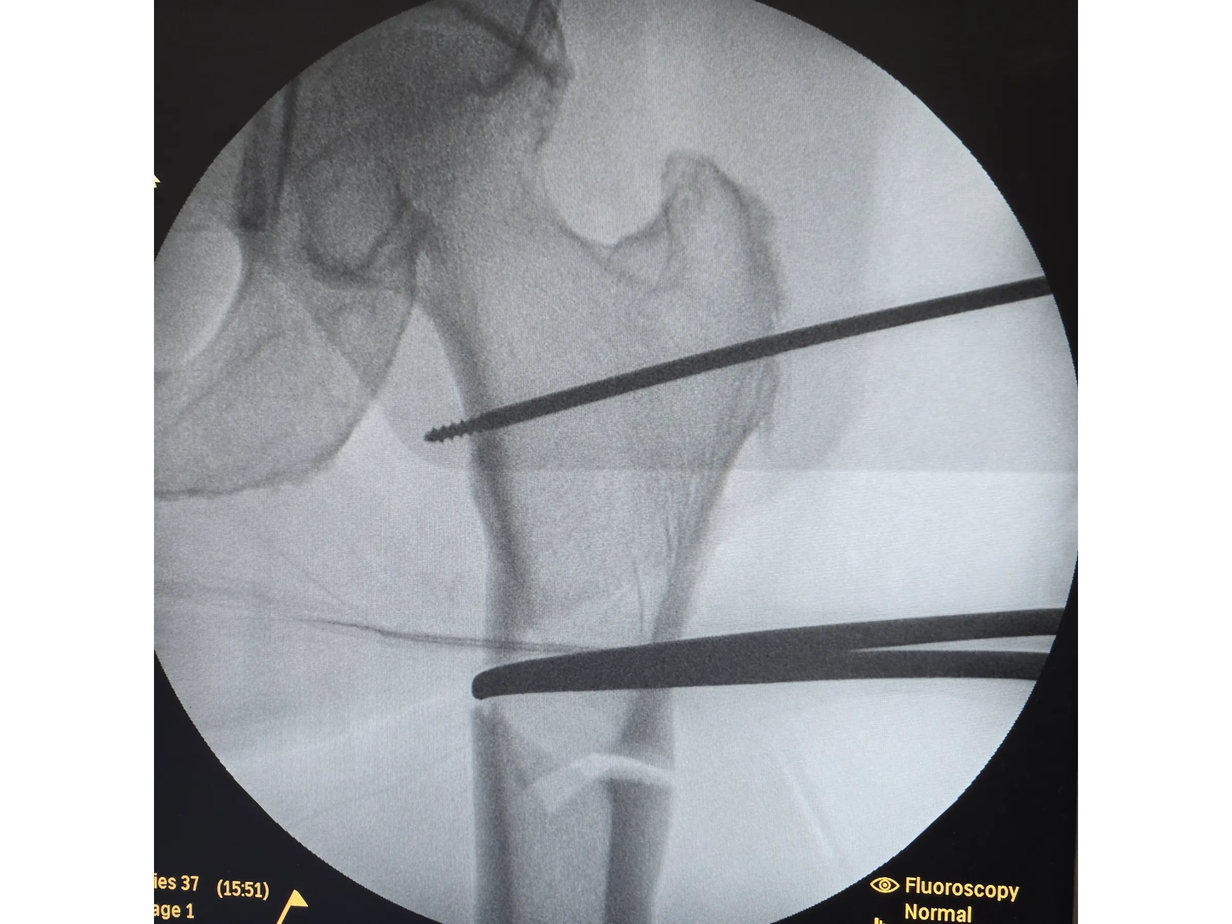 FRATURA SUBTROCANTERIANA [Caso 1] · Haste Intramedular Minimamente Invasiva