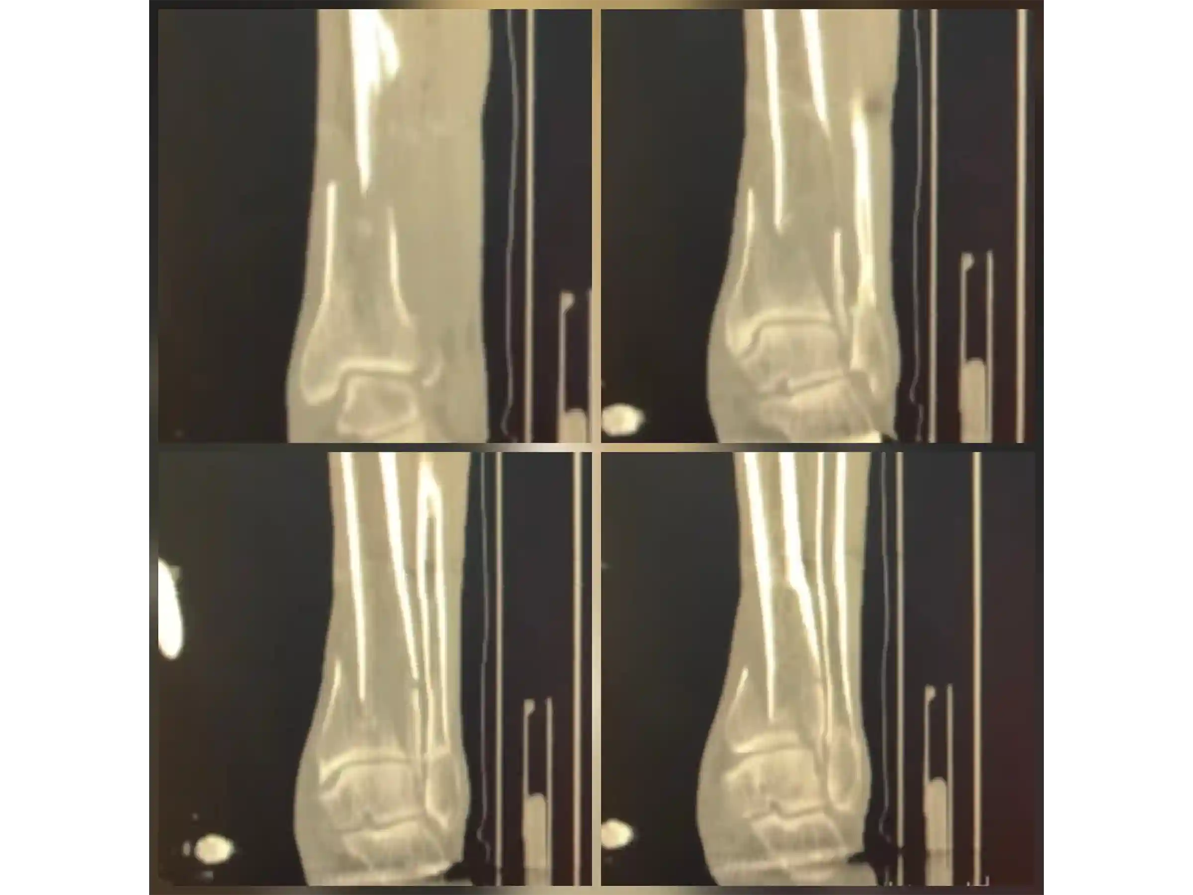 PILÃO TIBIAL [CASO 03] Abordagem Anterolateral e Posteromedial
