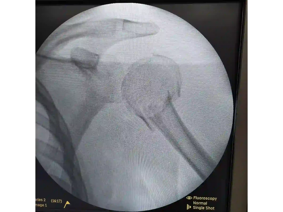 ÚMERO PROXIMAL [CASO 07] - Head-Split Em Paciente Jovem Placa E Parafusos