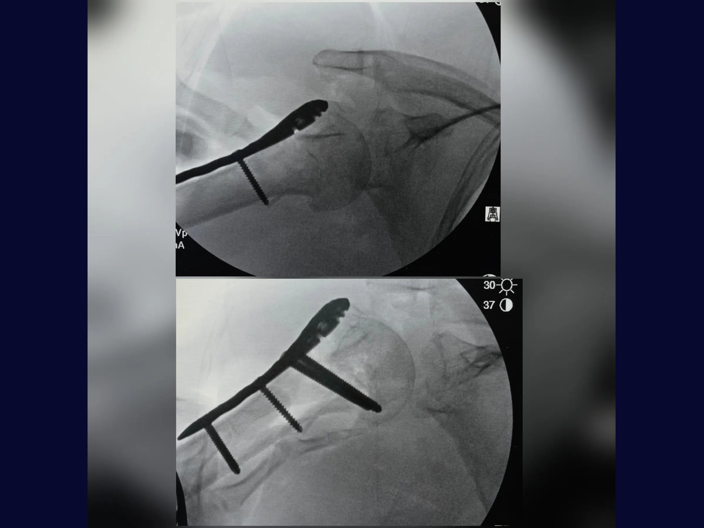 Úmero Proximal – Fratura em 4 Partes