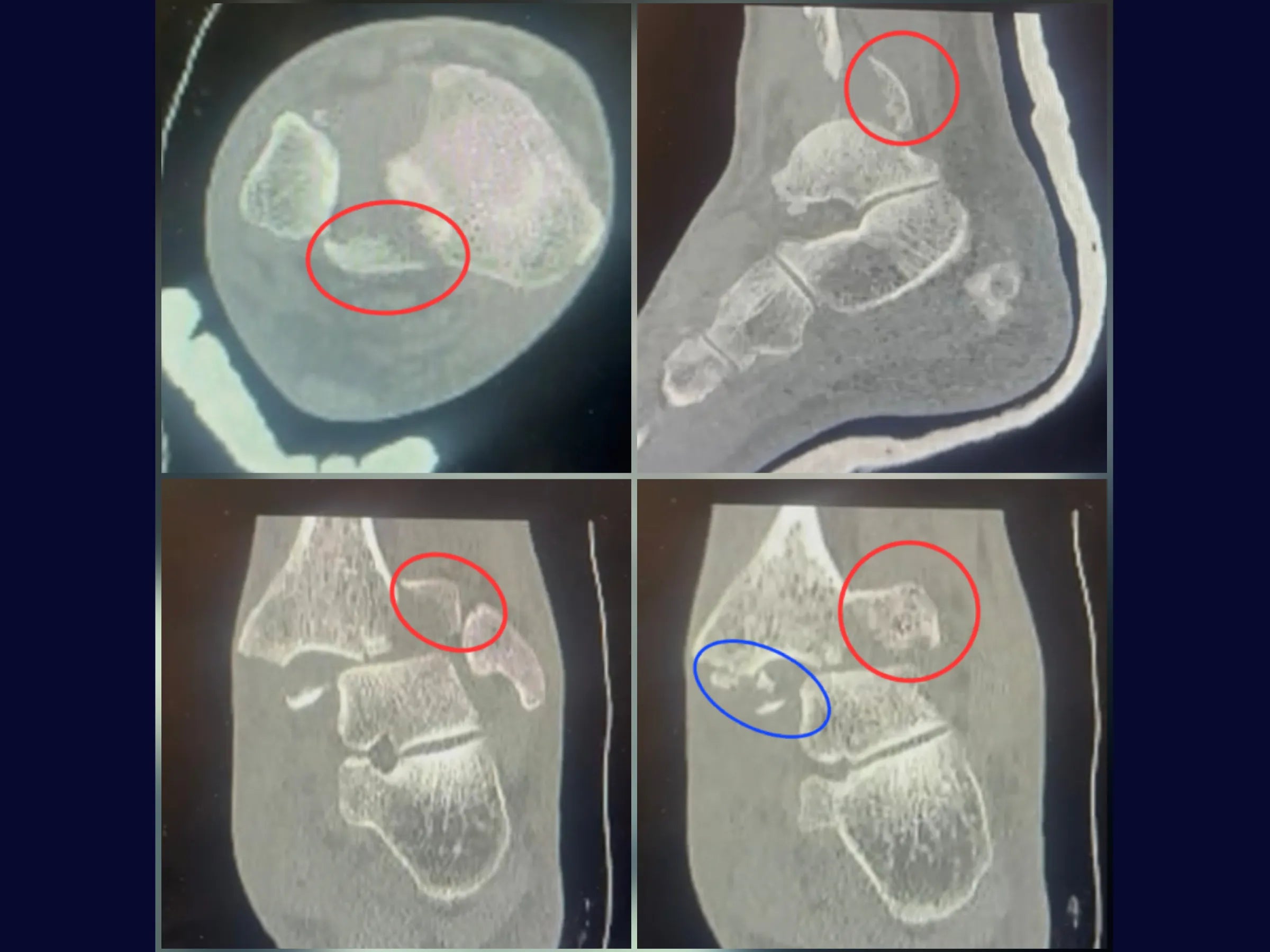 Fratura Trimaleolar - Abordagem em Decúbito Lateral