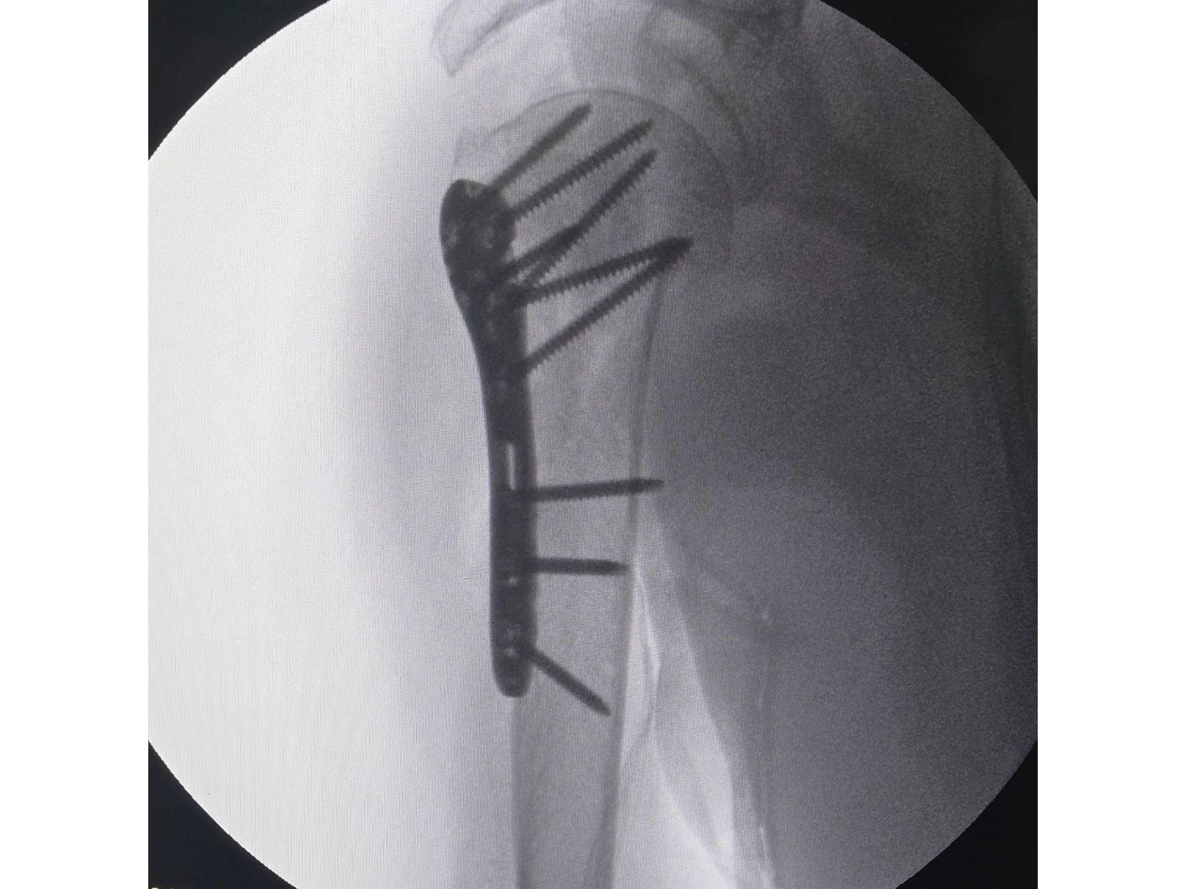 ÚMERO PROXIMAL [Caso 6] · Duas Partes · Placa e Parafusos