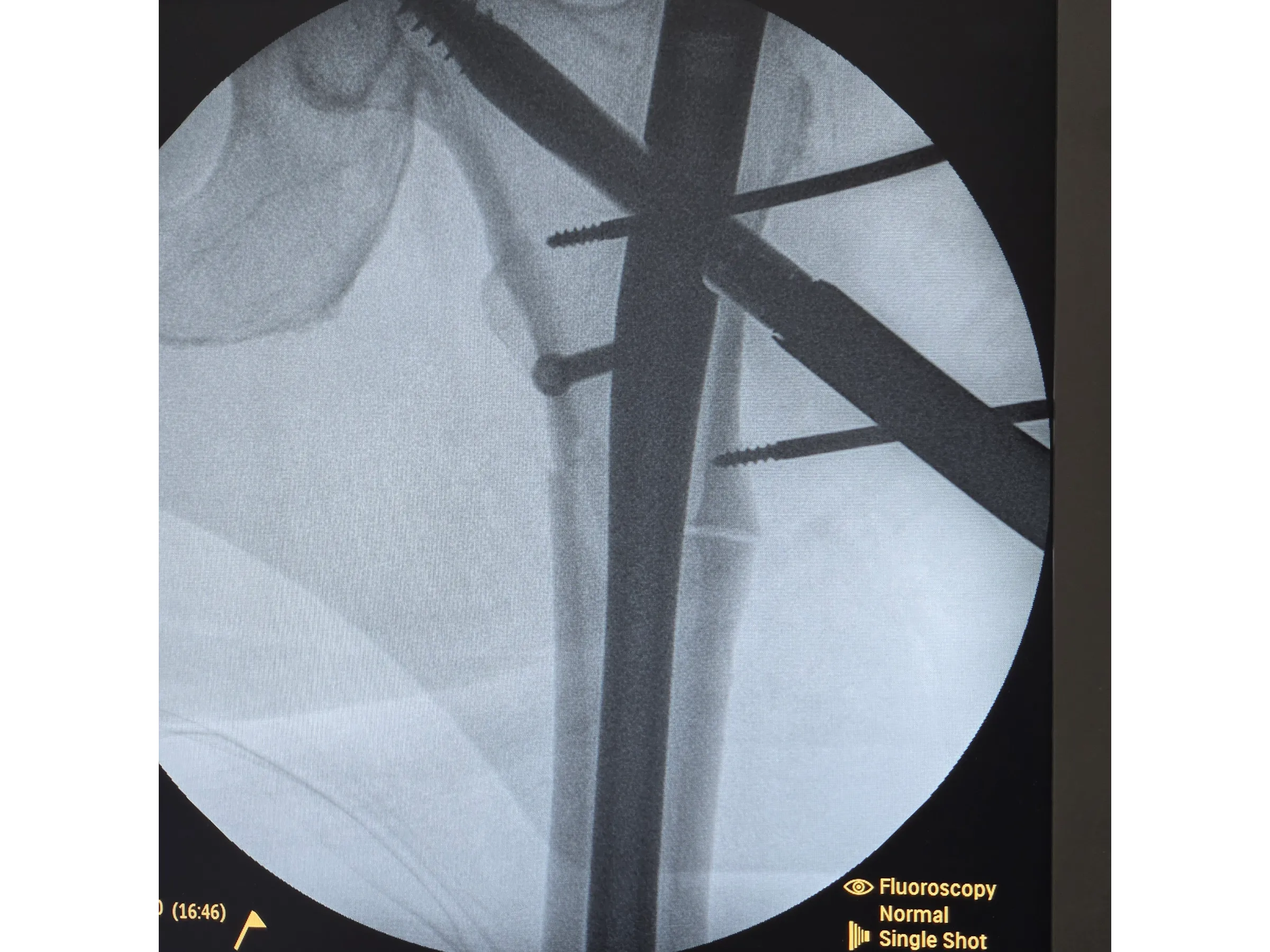 FRATURA SUBTROCANTERIANA [Caso 1] · Haste Intramedular Minimamente Invasiva