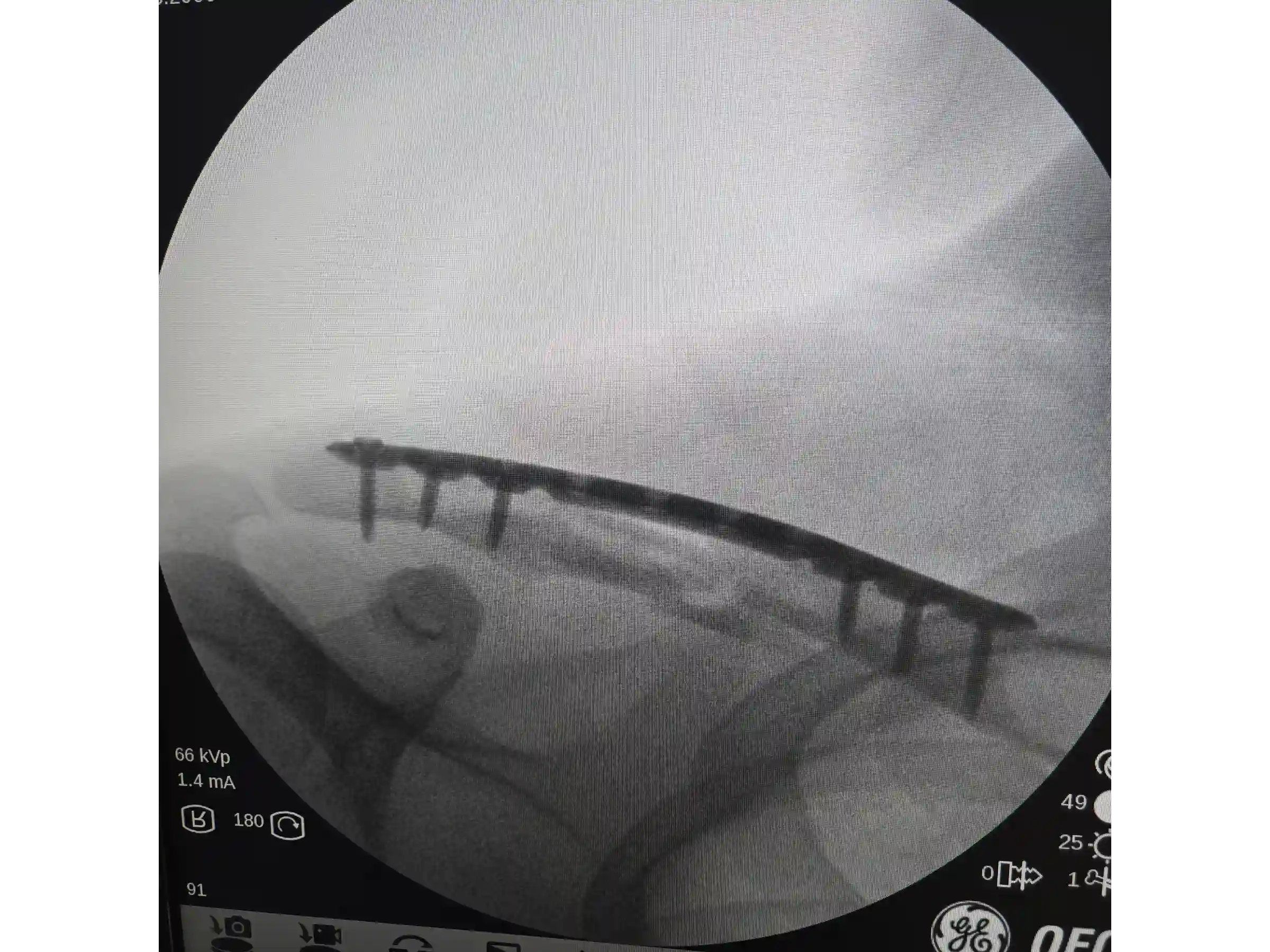 CLAVICLE [CASE 03] - Minimally Invasive Percutaneous Osteosynthesis