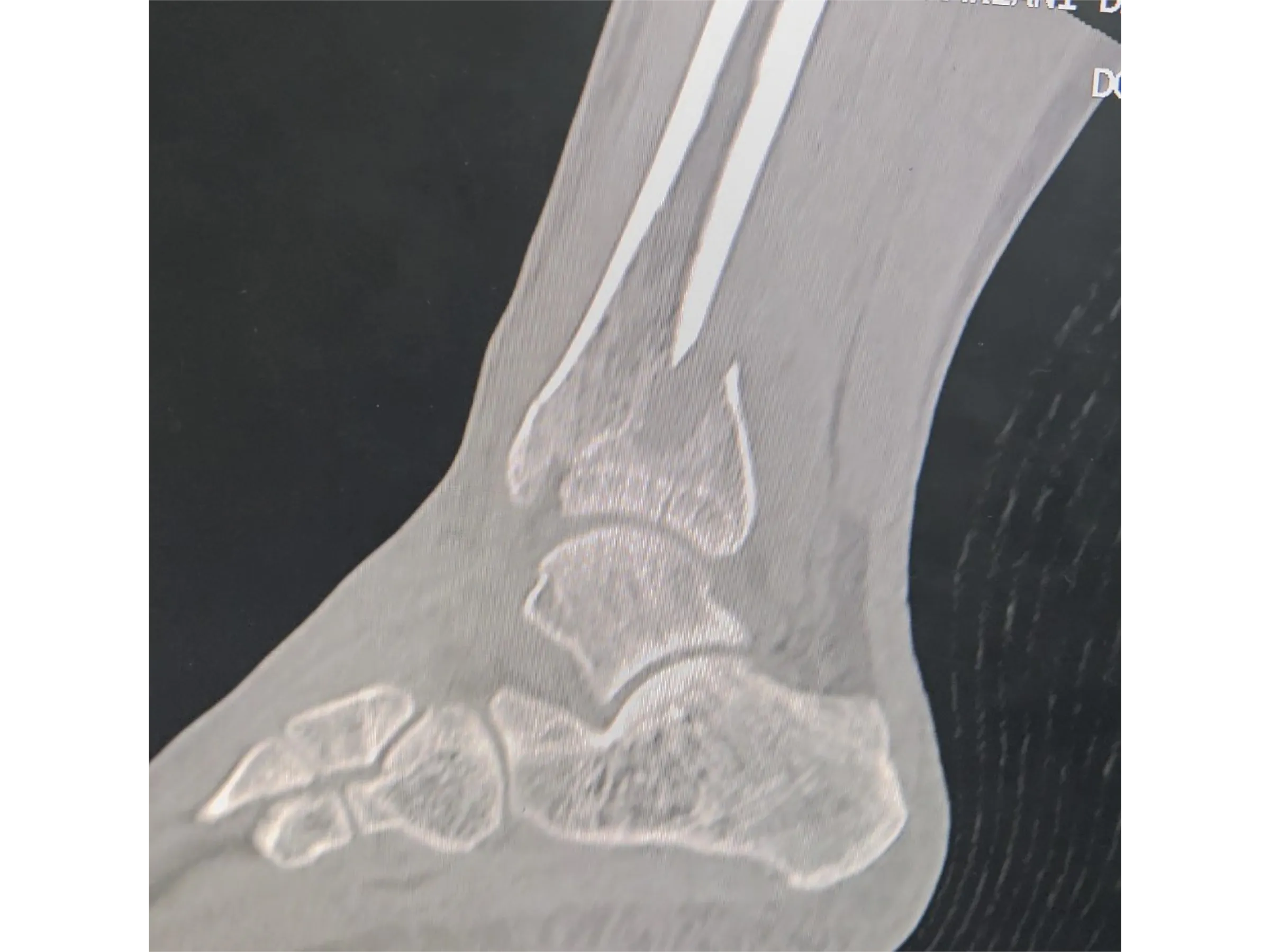 PILÃO TIBIAL [Caso 2] · Abordagem Póstero-Medial + Lateral