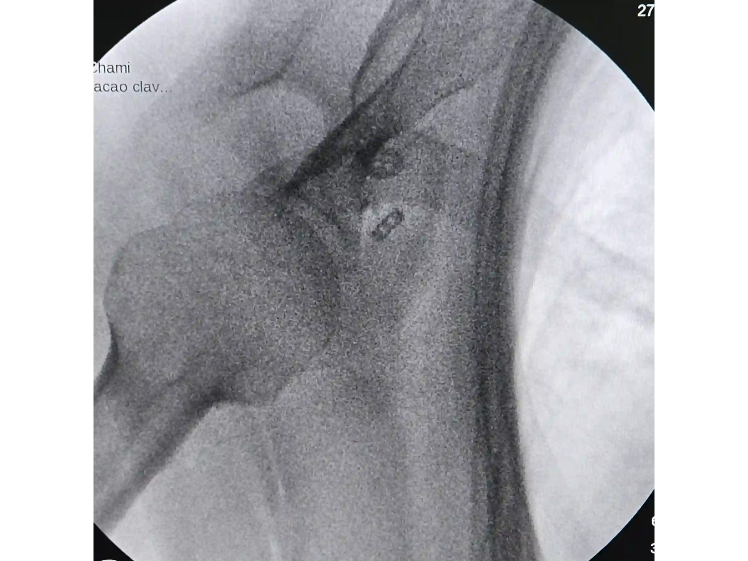 ACROMIOCLAVICULAR [CASO 3] Fixação com TightRope