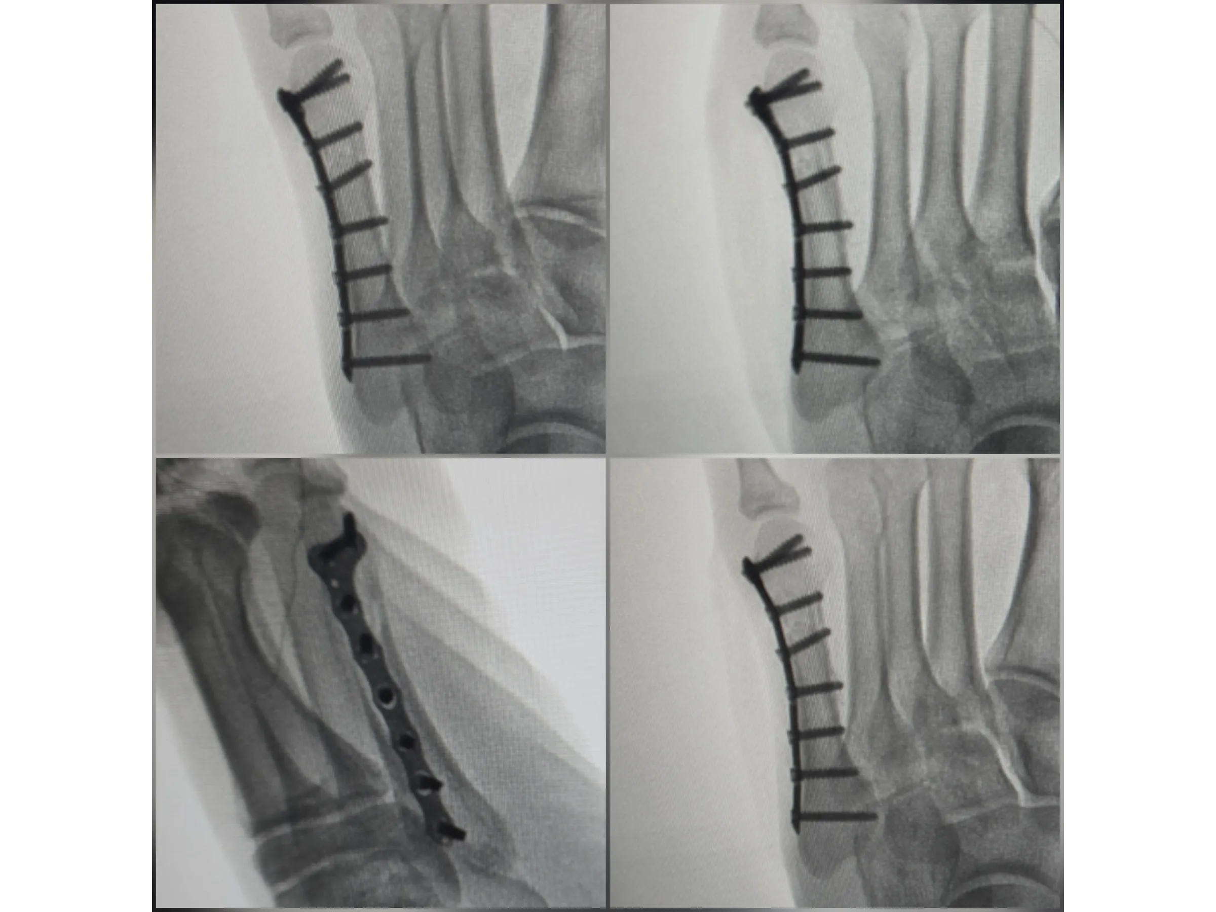 QUINTO METATARSO [Caso 2] · Placa e Parafusos de Minifragmentos