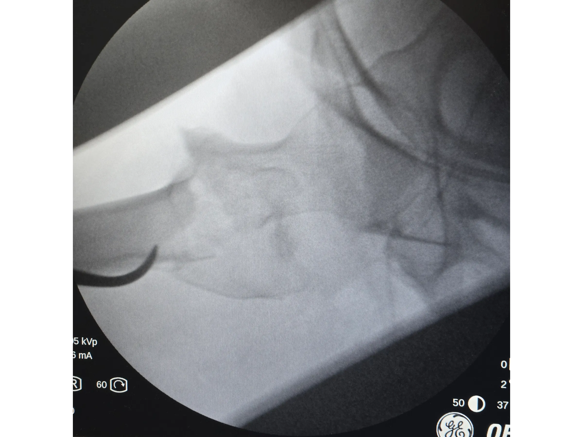 FÊMUR PROXIMAL [Caso 4] · Dupla Técnica da Gangorra