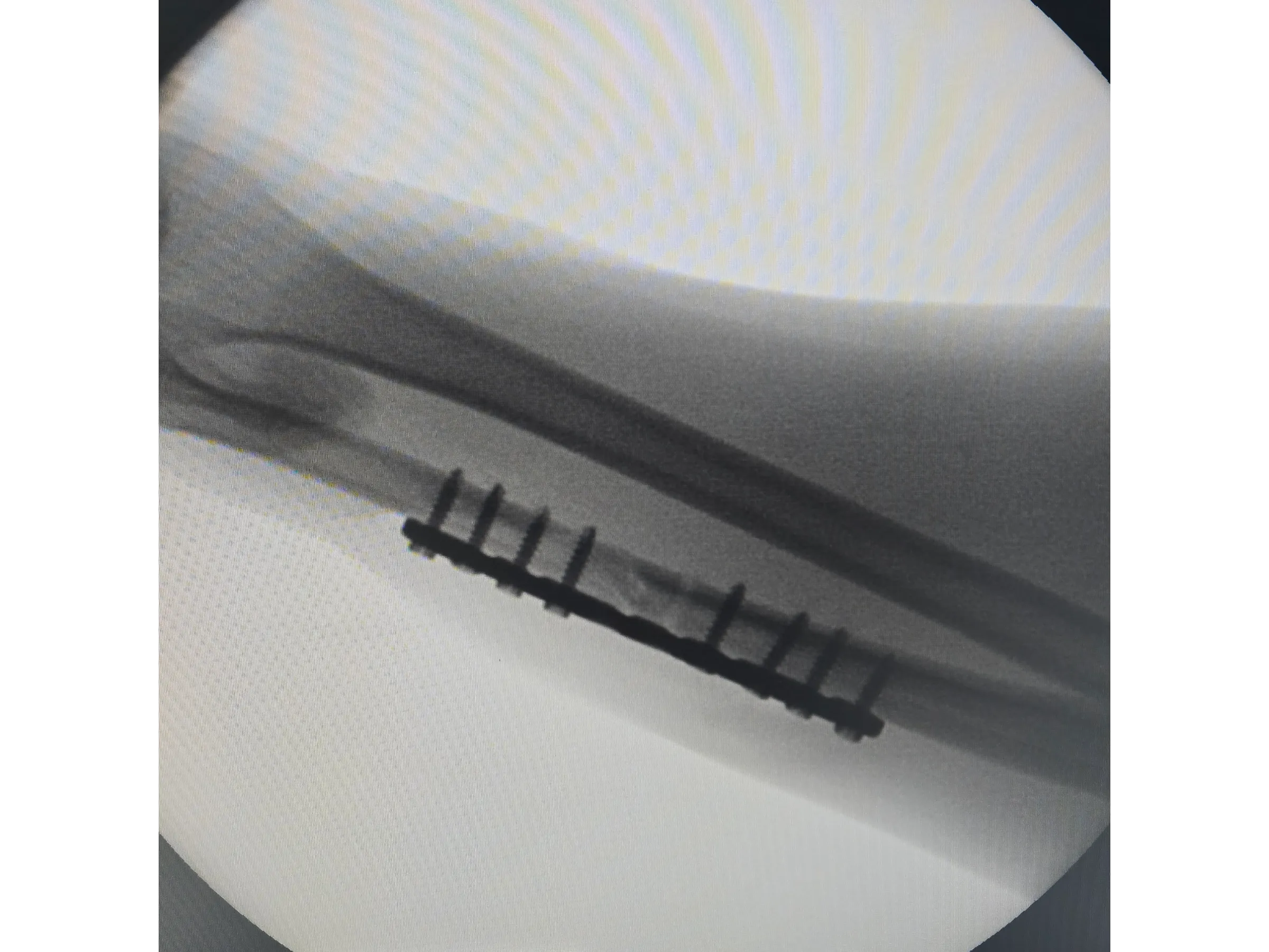 DIÁFISE DA ULNA [Caso 2] · Placa e Parafusos
