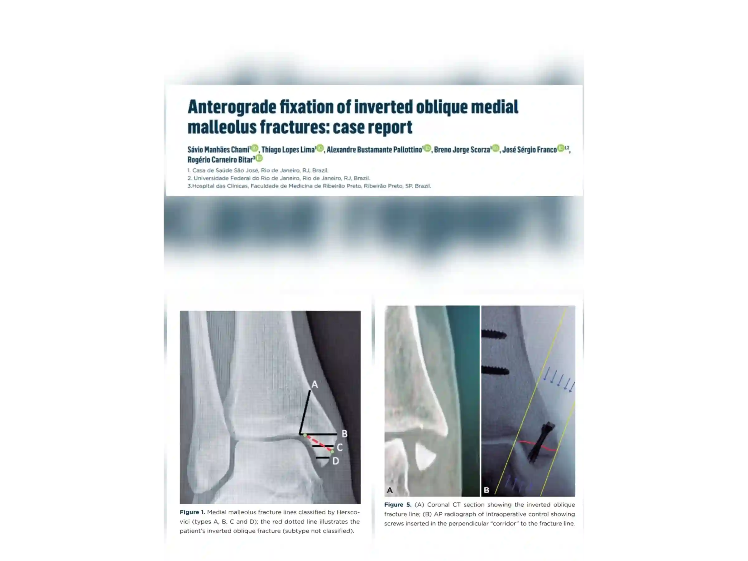 TRIMALEOLAR [CASO 03] Abordagem posterolateral + fixação anterógrada do maléolo medial