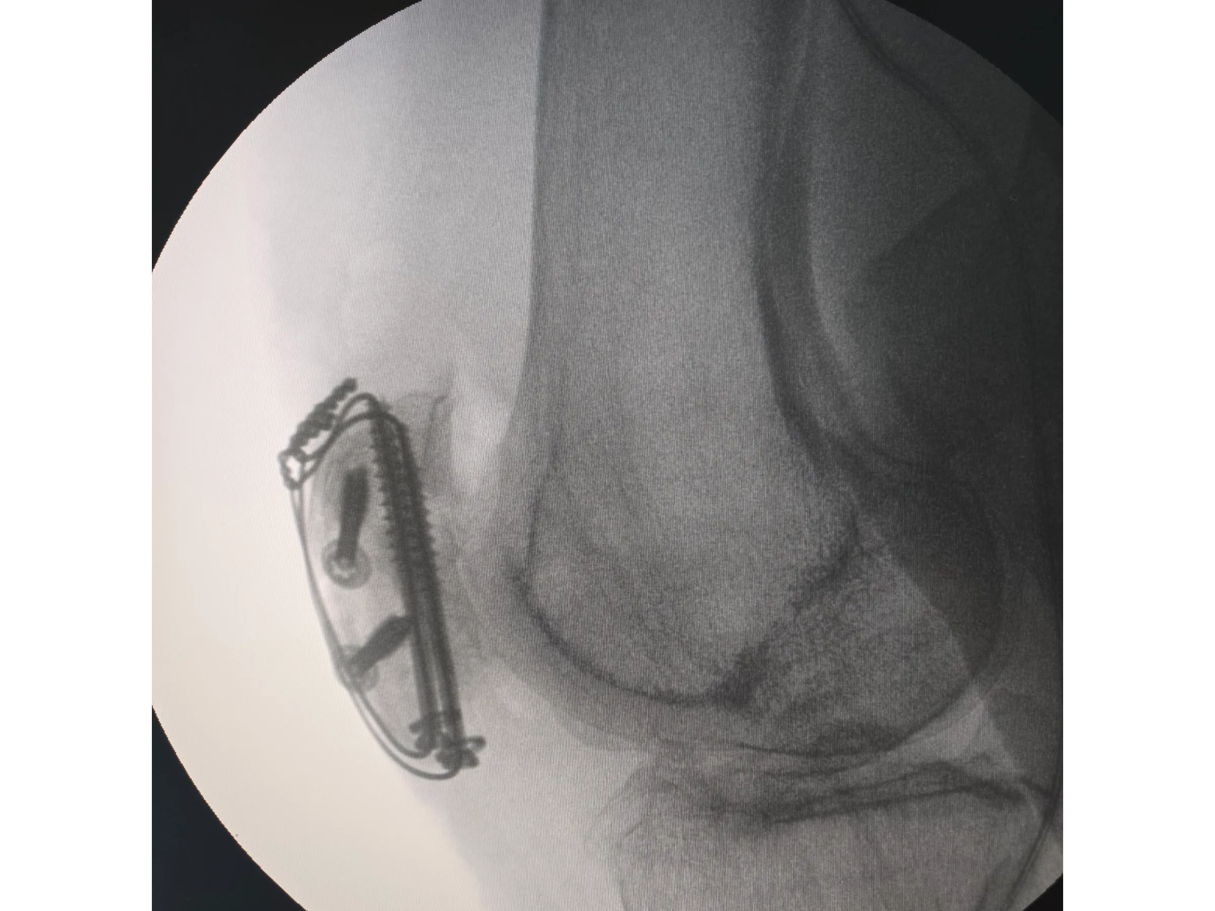 PATELA [Caso 2] · Parafusos Canulados + Cerclagem