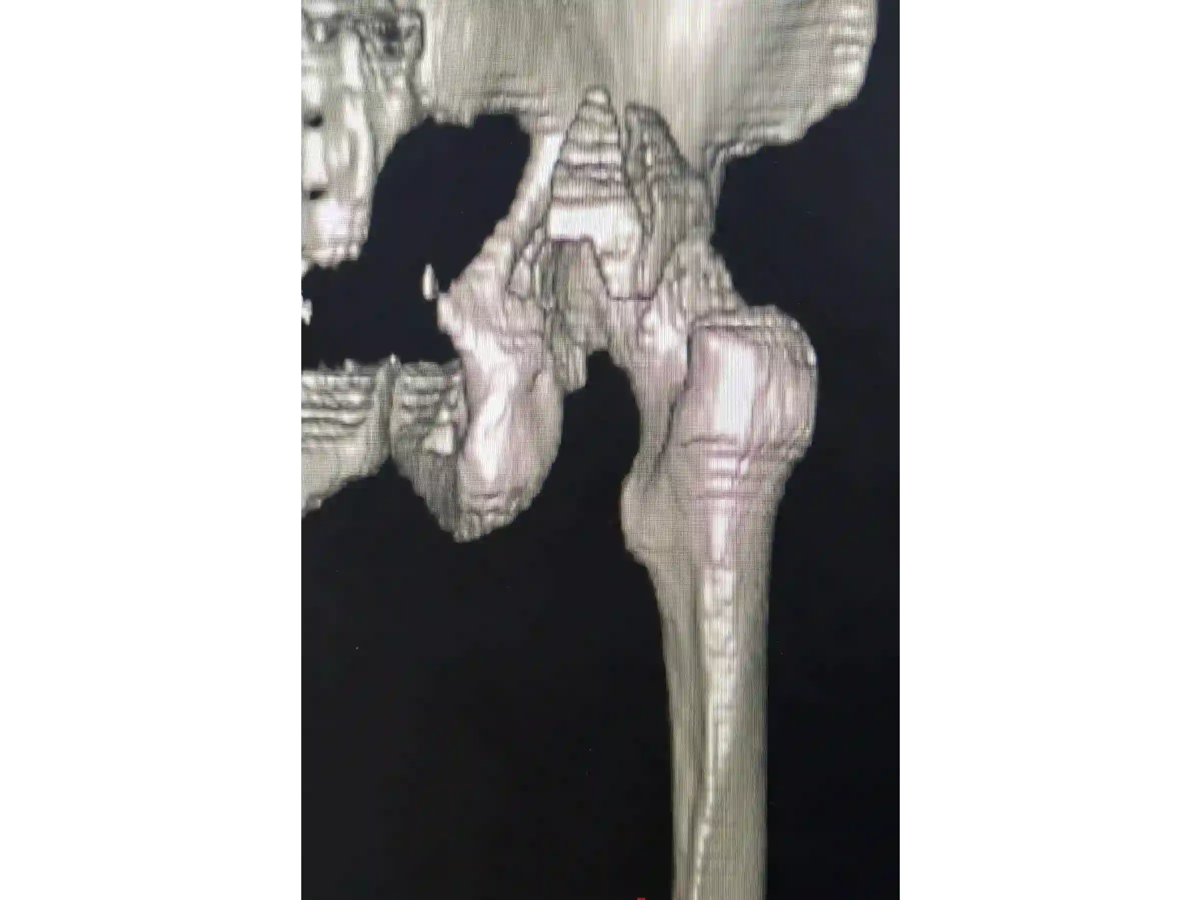 ACETÁBULO [CASO 02] · Rebordo Posterior + Impacção Articular