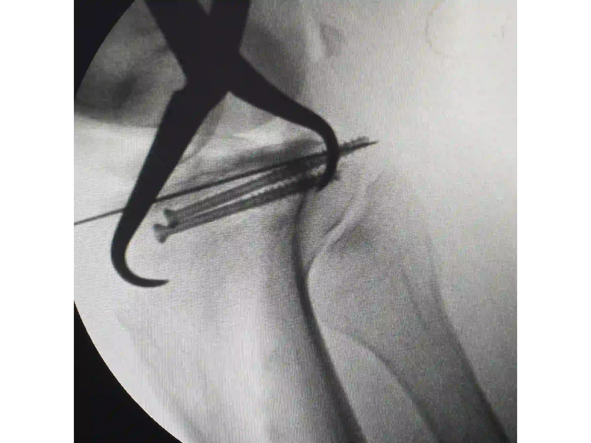PLANALTO TIBIAL [CASO 03] Jail Technique Afundamento Posterolateral