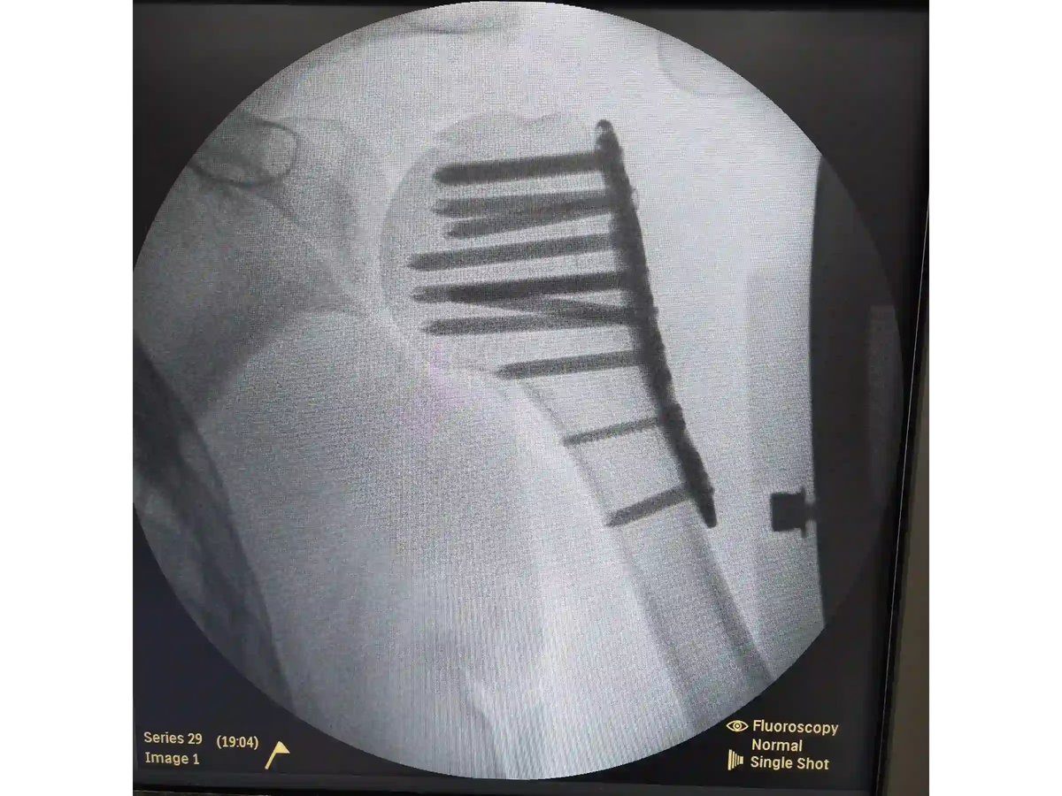ÚMERO PROXIMAL [CASO 07] - Head-Split Em Paciente Jovem Placa E Parafusos