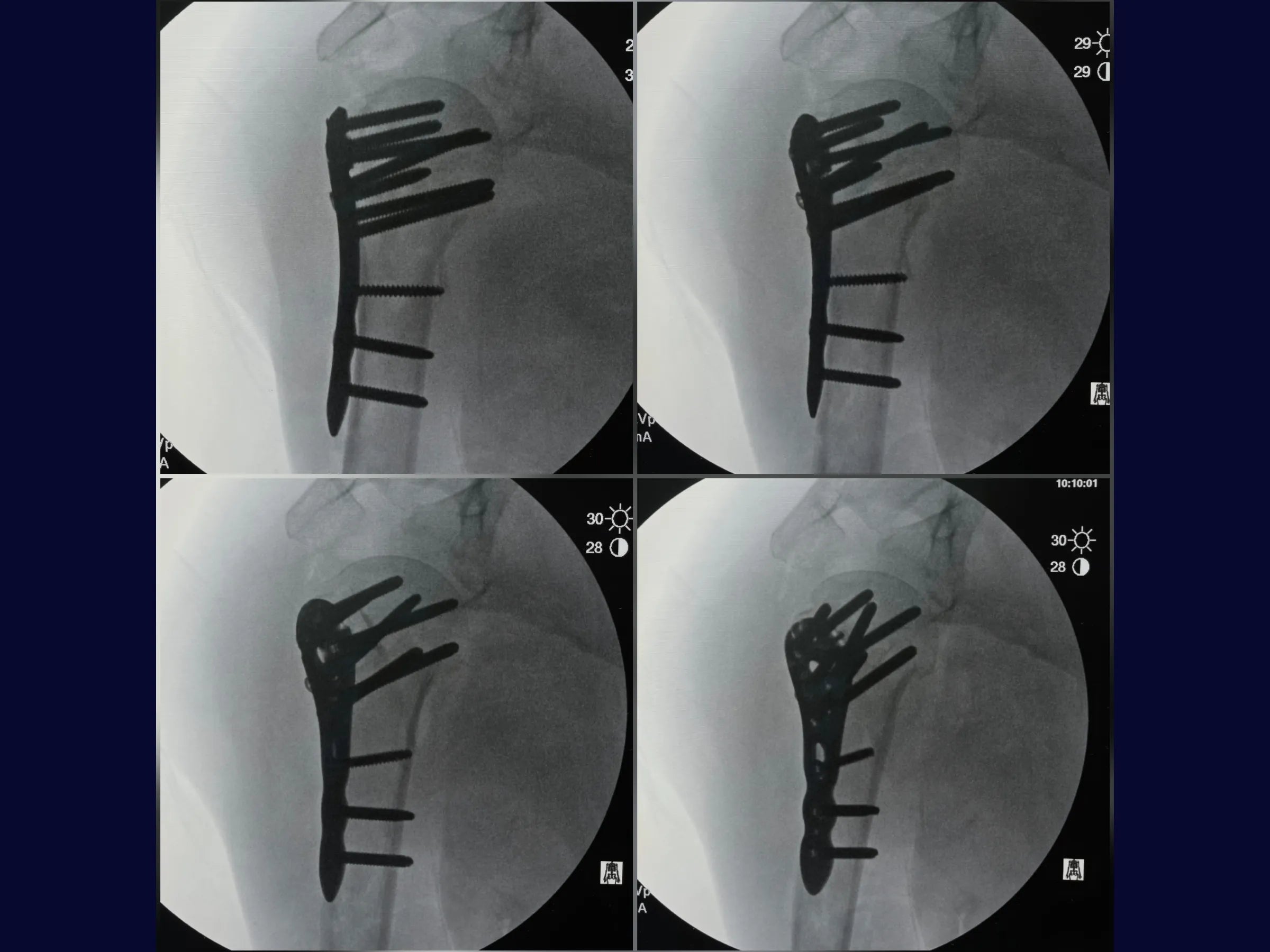 Úmero Proximal – Fratura em 4 Partes