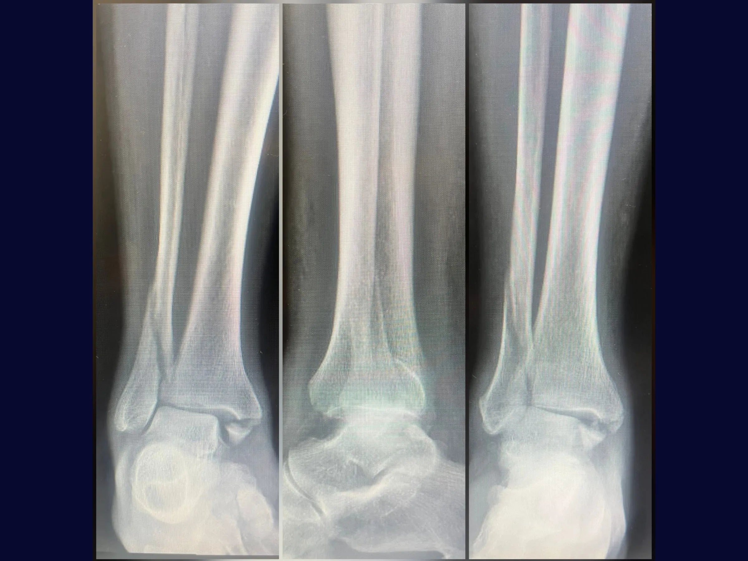 Fratura Trimaleolar - Abordagem em Decúbito Lateral