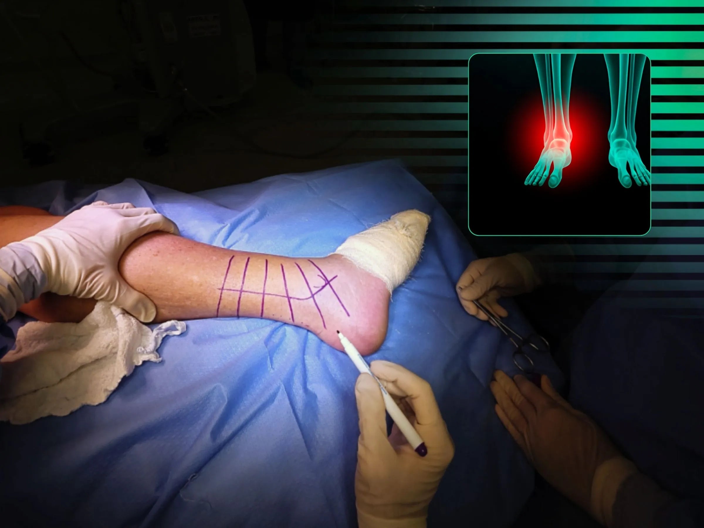 Fratura Trimaleolar - Abordagem em Decúbito Lateral