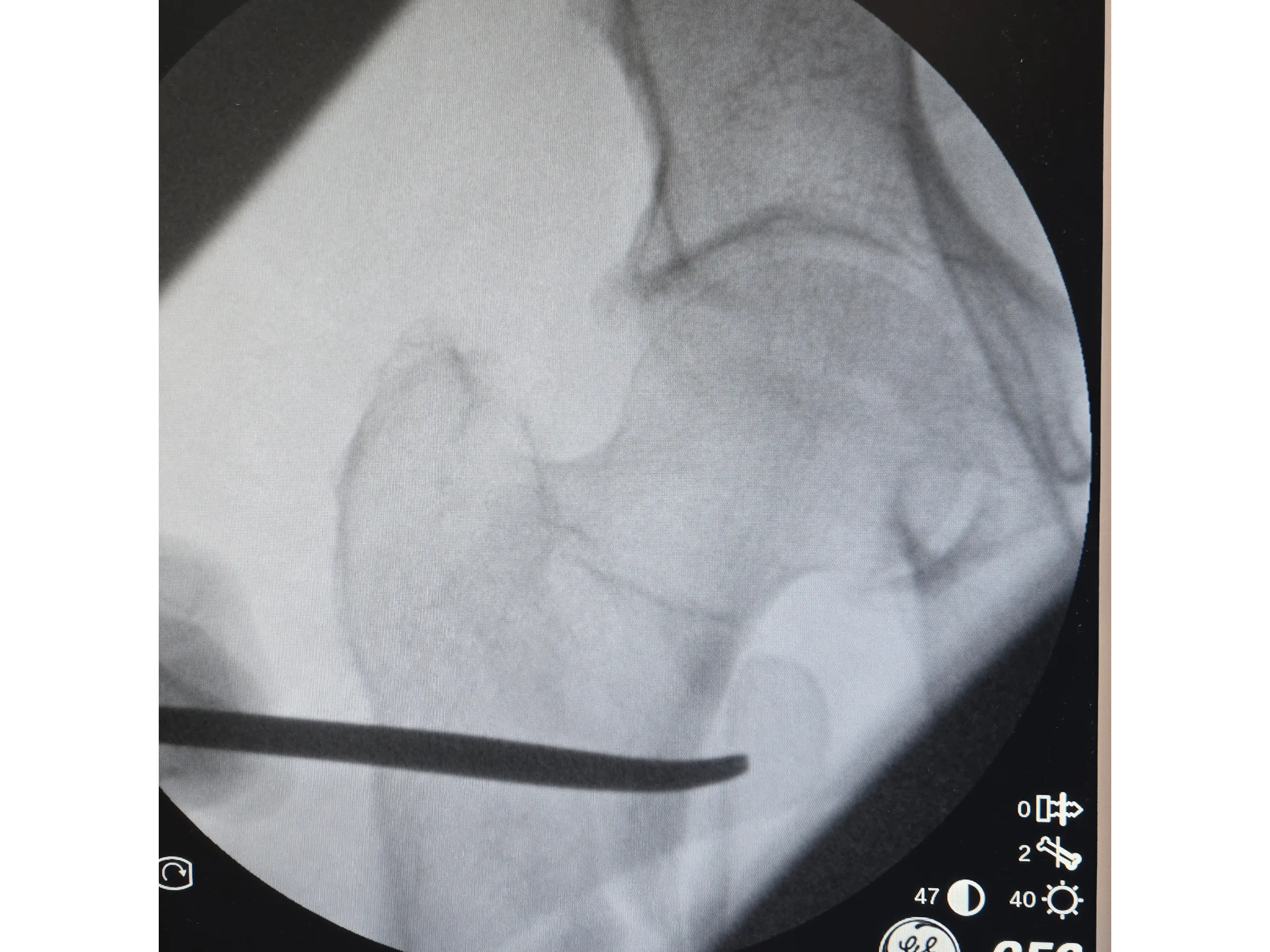 FÊMUR PROXIMAL [Caso 4] · Dupla Técnica da Gangorra