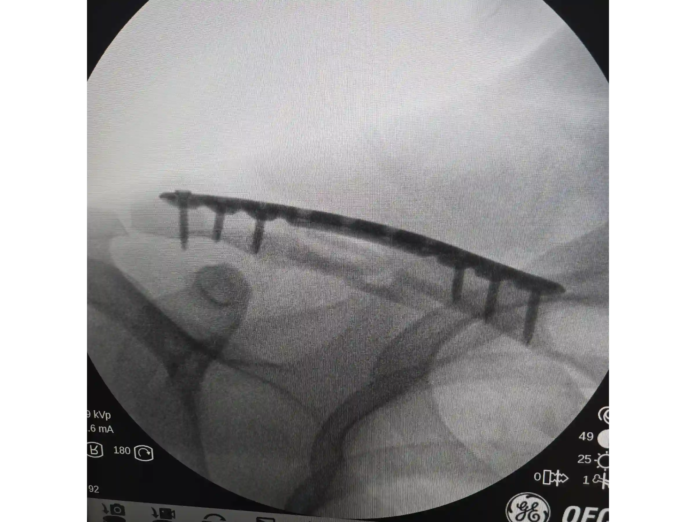 CLAVICLE [CASE 03] - Minimally Invasive Percutaneous Osteosynthesis