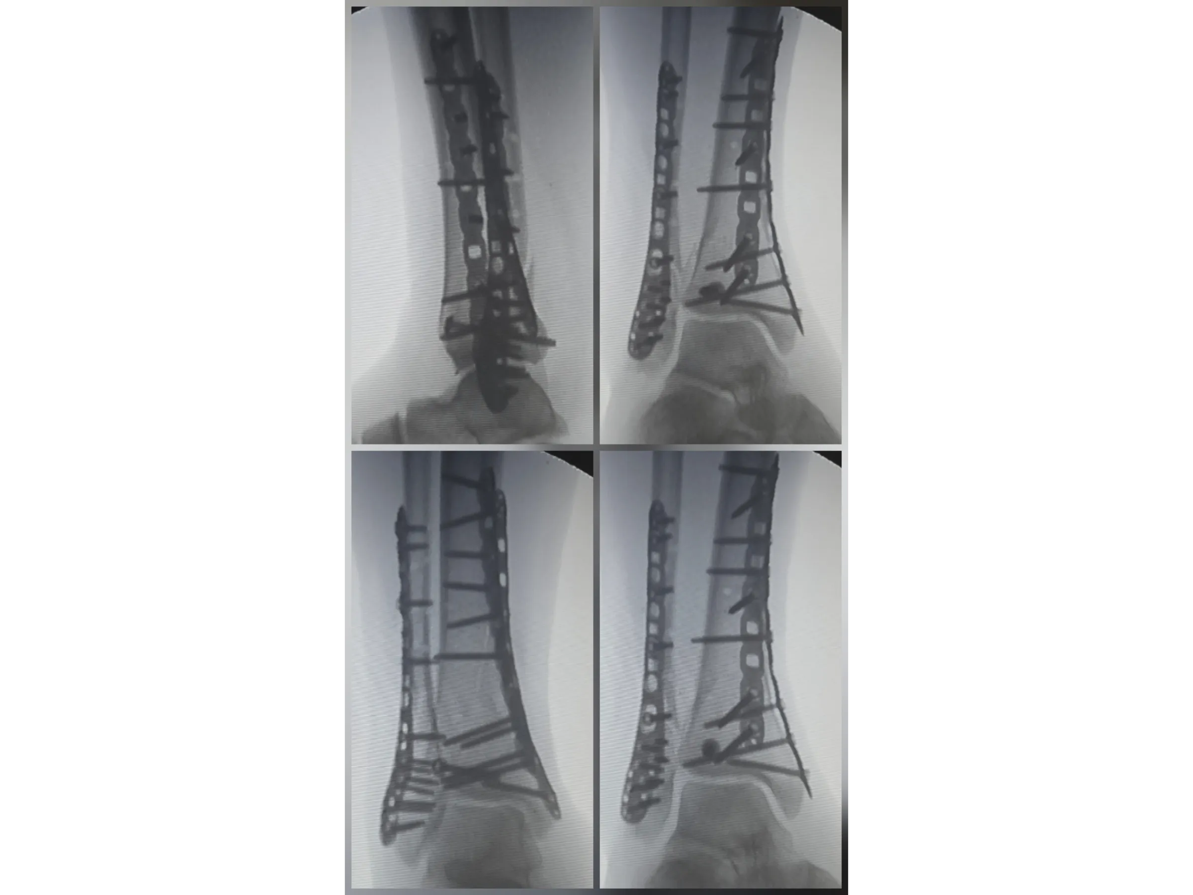 PILÃO TIBIAL [Caso 2] · Abordagem Póstero-Medial + Lateral