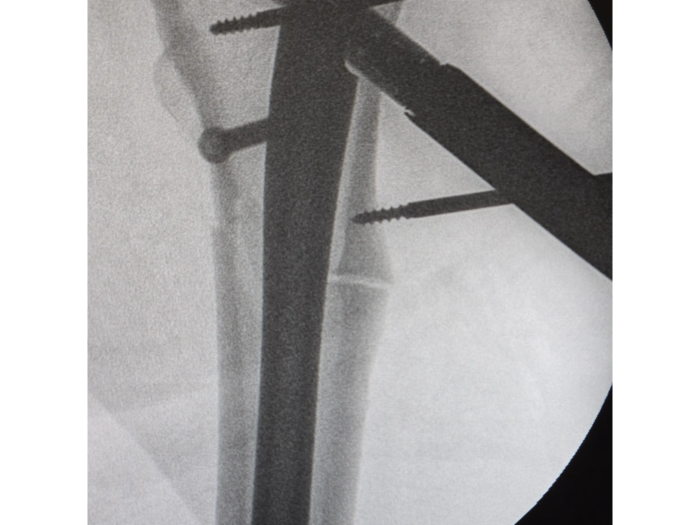 FRATURA SUBTROCANTERIANA [Caso 1] · Haste Intramedular Minimamente Invasiva