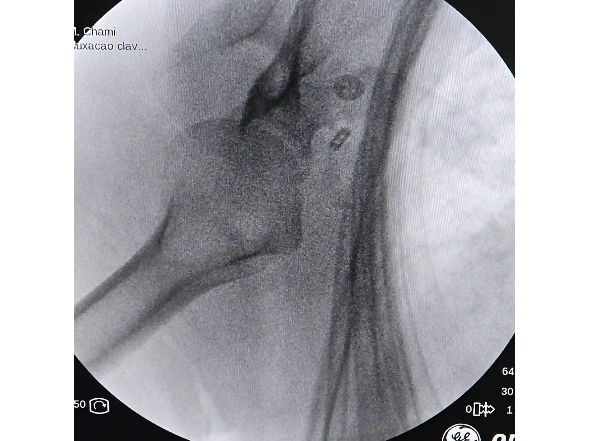 ACROMIOCLAVICULAR [CASO 3] Fixação com TightRope