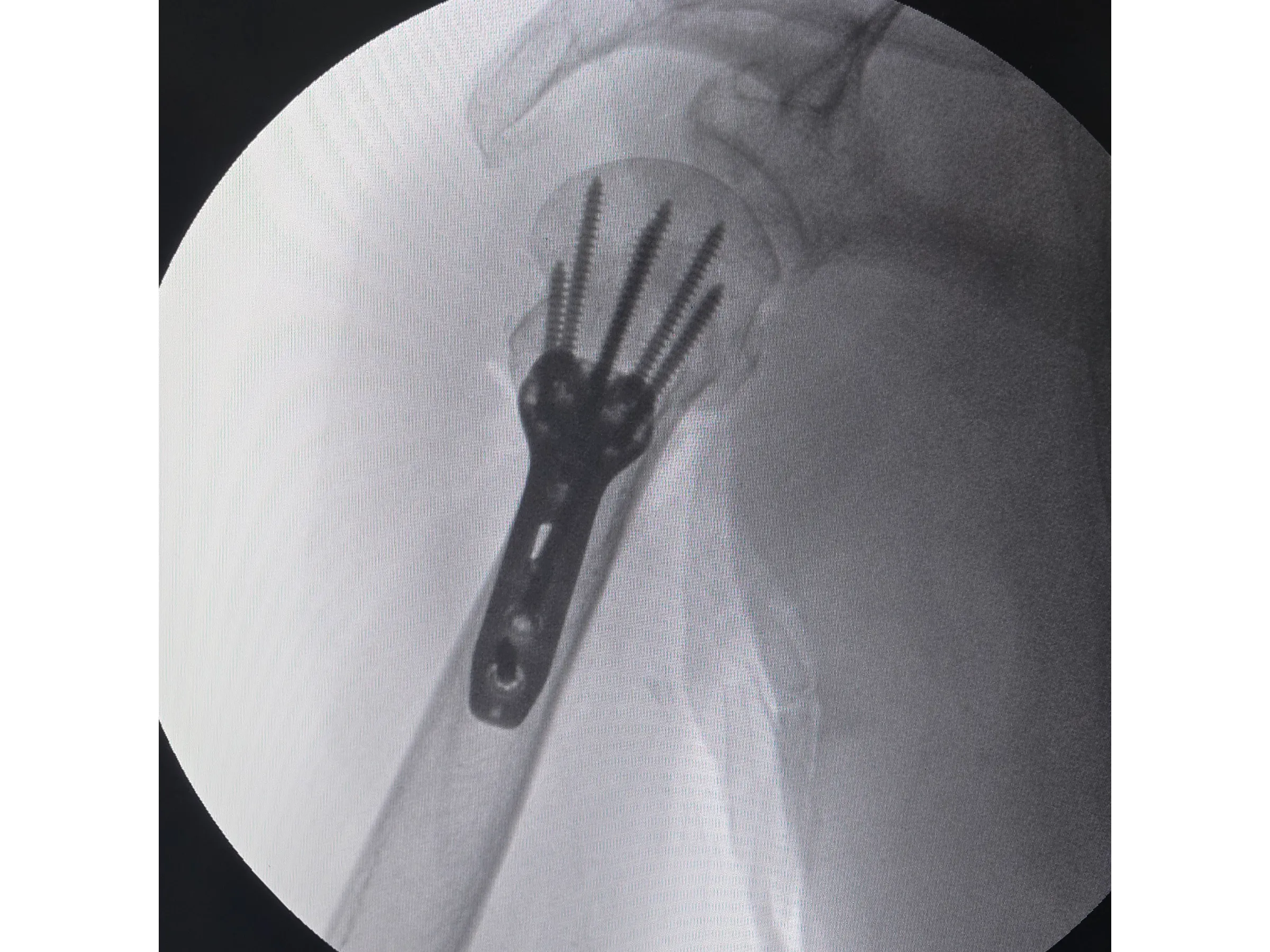 ÚMERO PROXIMAL [Caso 6] · Duas Partes · Placa e Parafusos