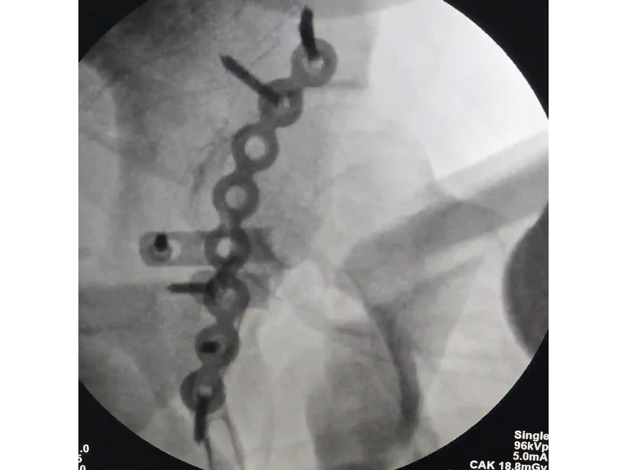 ACETÁBULO [CASO 02] · Rebordo Posterior + Impacção Articular