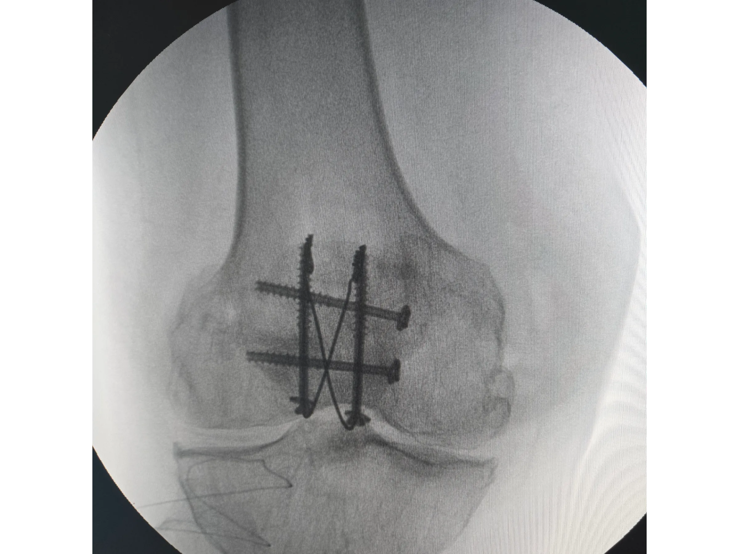 PATELA [Caso 2] · Parafusos Canulados + Cerclagem