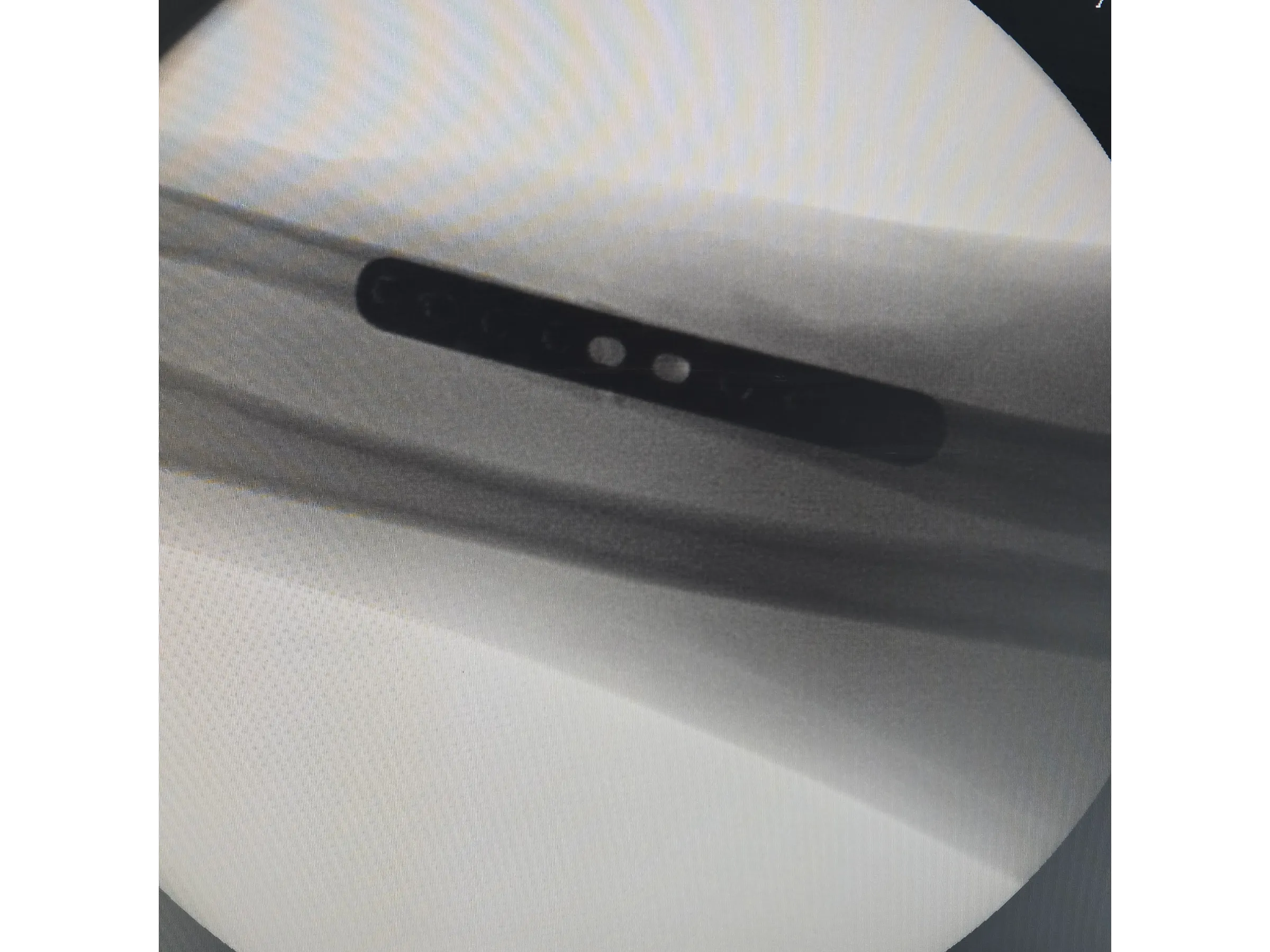 DIÁFISE DA ULNA [Caso 2] · Placa e Parafusos