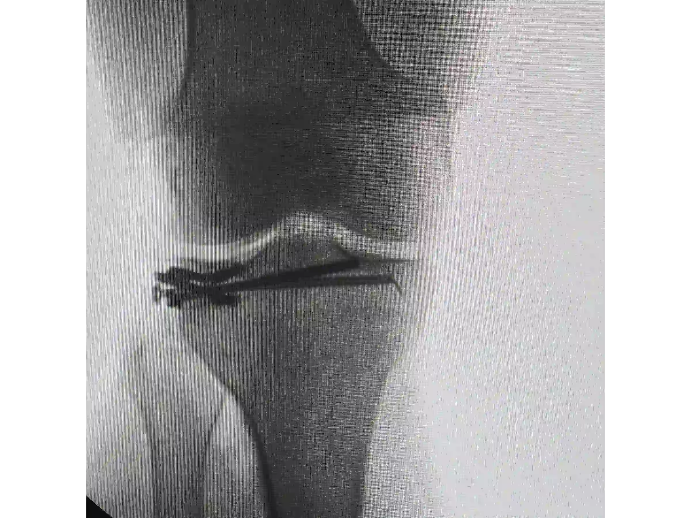 PLANALTO TIBIAL [CASO 03] Jail Technique Afundamento Posterolateral
