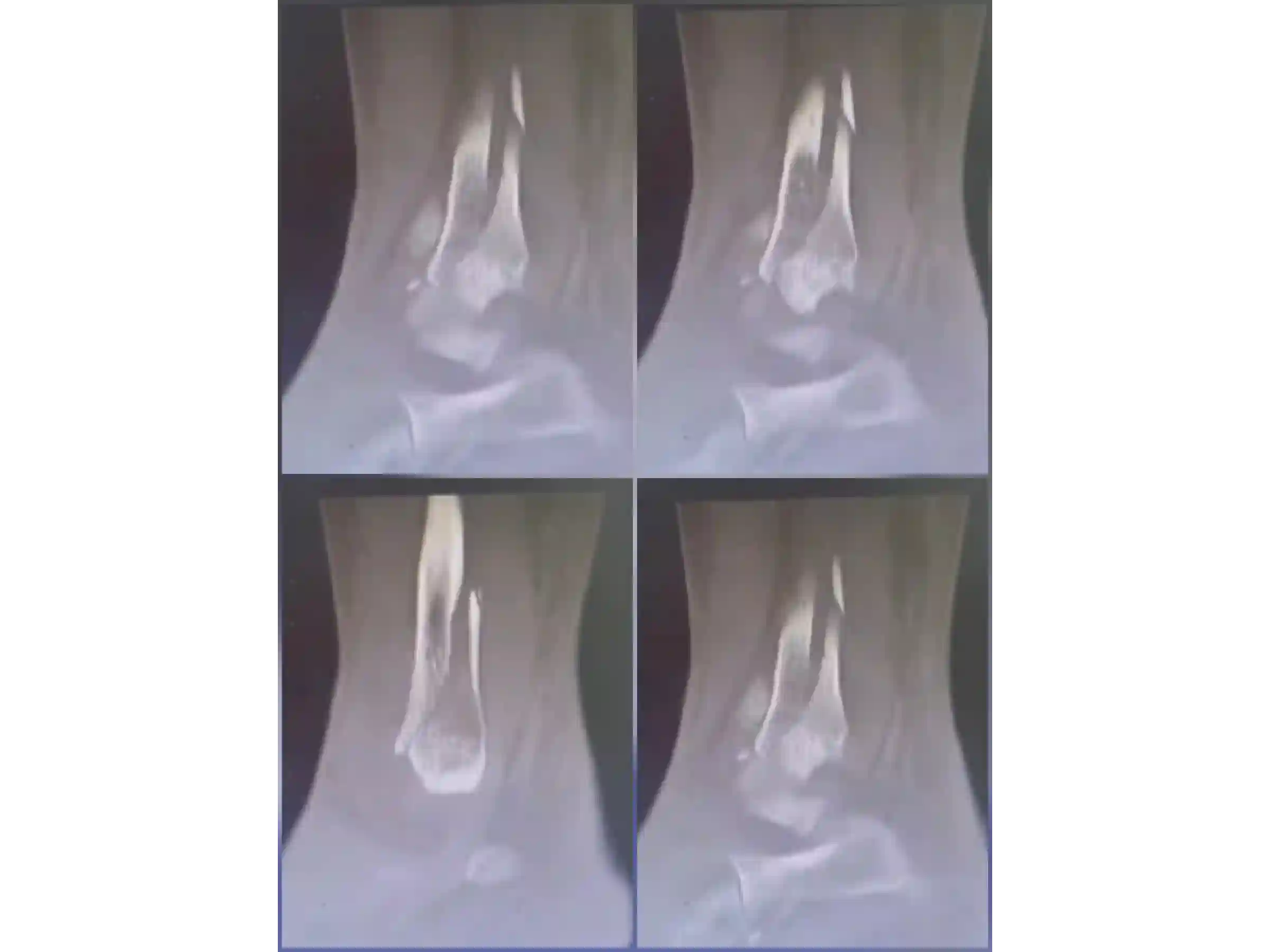 TRIMALEOLAR [CASO 03] Abordagem posterolateral + fixação anterógrada do maléolo medial