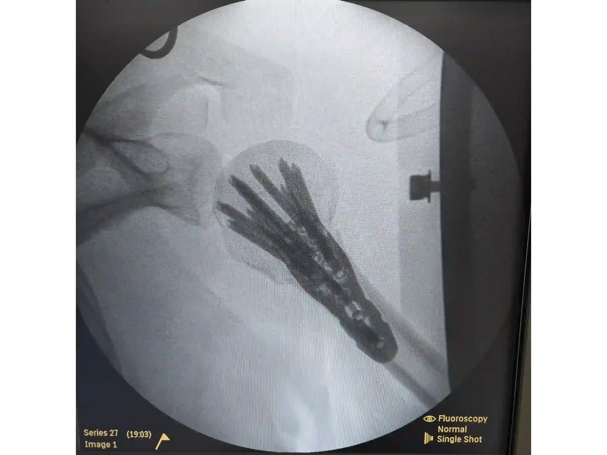 ÚMERO PROXIMAL [CASO 07] - Head-Split Em Paciente Jovem Placa E Parafusos