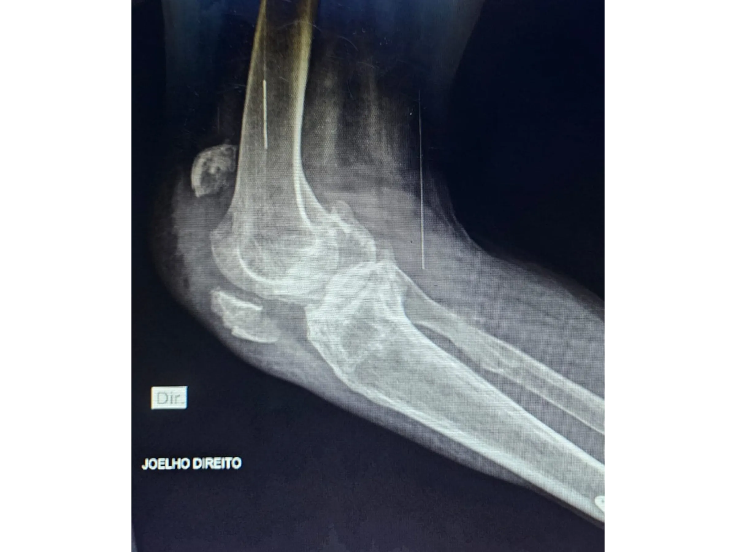 PATELA [Caso 2] · Parafusos Canulados + Cerclagem