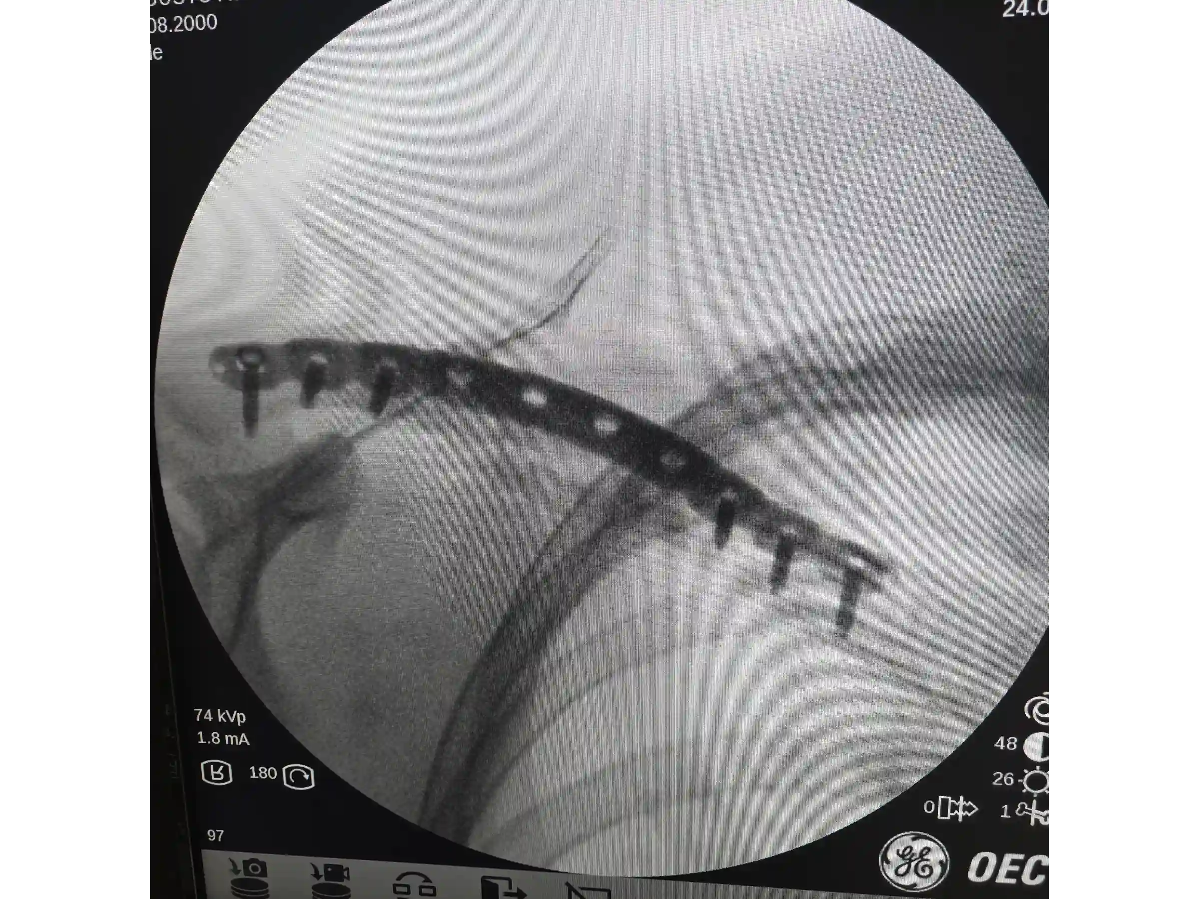 CLAVICLE [CASE 03] - Minimally Invasive Percutaneous Osteosynthesis